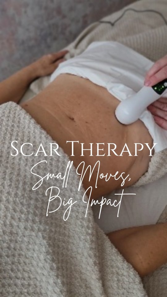 Scar Massage Therapy Works Wonders
No matter how old your scar is, scar massage therapy will help soften the tissue, improve flexibility, and reduce tightness.
Just a few minutes a day can:
Break down thick, raised tissue
Boost circulation for healing
Fade the scar’s appearance over time
Consistency is key. Scars tell a story—but with the right care, they don’t have to define you.
#ScarMassage #ScarTherapy #HealingSkin #SkinCareJourney #PostSurgeryCare #restorescartherapy #restorescartherapypractitioner #tatjanasenkova #newburyberkshire