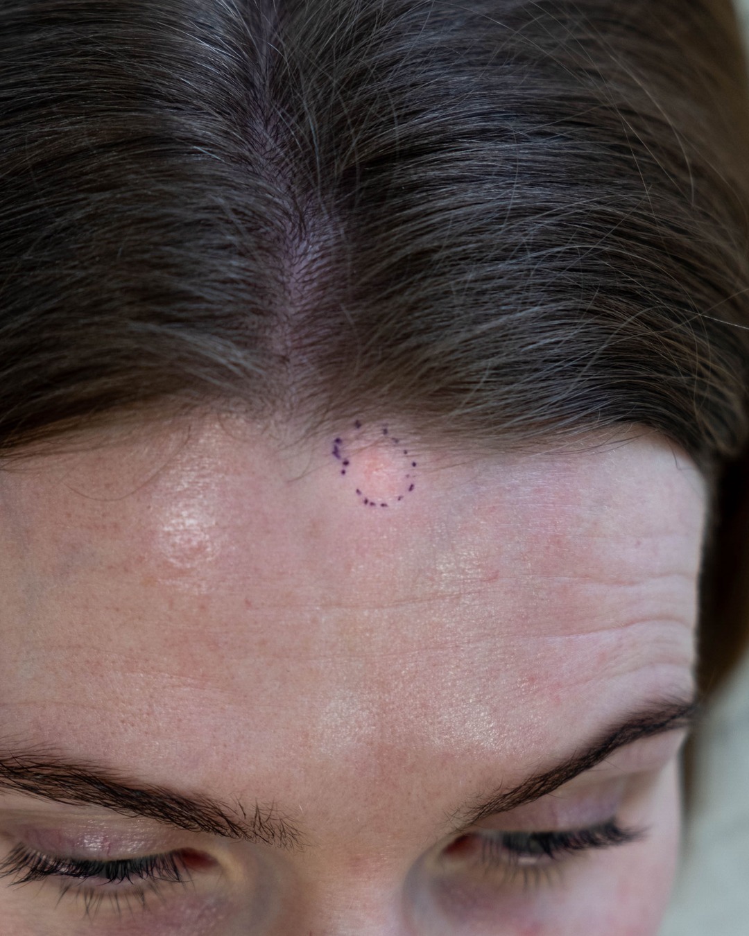May is National Skin Cancer Awareness Month so we wanted to take this opportunity to share our founder Larissa's journey and encourage you to get your moles and blemishes checked!
At the start of this year, Larissa found out she had skin cancer at the top of her forehead.
Using our newly acquired Map My Mole service, she was able to photograph the very subtle blemish at the top of her head using a Dermatoscope to detect some suspicious characteristics and send it off for a second opinion.
After further investigation, she got the diagnosis that it was a BCC (basal cell carcinoma) and would need removing as soon as possible to prevent further issues.
The removal was incredibly successful and you can see here how it looked before, during and after removal. The scar has continued to heal well and should be barely noticeable once fully healed!
Although a scary experience, Larissa is extremely grateful to have had access to the resources she did at The Expert Skin Clinic.
She's channelled what she's learnt from this experience into helping others and spreading awareness about skin cancer; including the use of dangerous cosmetic treatments like sun beds (swipe to see Larissa back in her sun bed days!)
Map My Mole aims to provide an accessible mole mapping service that contributes to the early detection and prevention of skin cancer.
If you're concerned about any blemish or mole on your skin, take this as your sign that it's well worth getting it checked out for peace of mind or early detection if there's an issue. You can do this on our website by booking the 'mole/lesion screening'.
@mapmymole are also sharing helpful resources throughout this month and beyond on what to look out for and how to protect your skin so they're definitely worth a follow!
