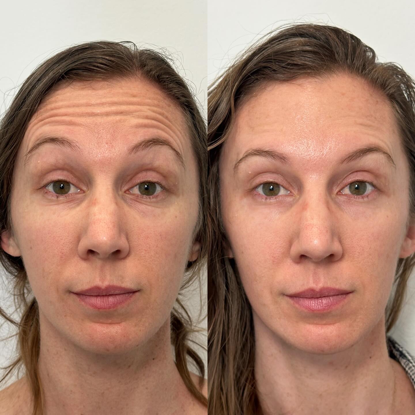 Fresh, smooth, and still you ✨
This beauty came in wanting to soften lines while keeping just a touch of natural movement—and we delivered. Her brows are lifted, the shape balanced, her skin is glowing, and those fine lines? Gently blurred for a fresh, effortless look. The perfect balance of refined and expressive 💉
#BotoxBeforeAndAfter #SmoothNotFrozen #StarkAesthetics #NaturalResults #jeuveau #fillers #beverlyhillsmedspa