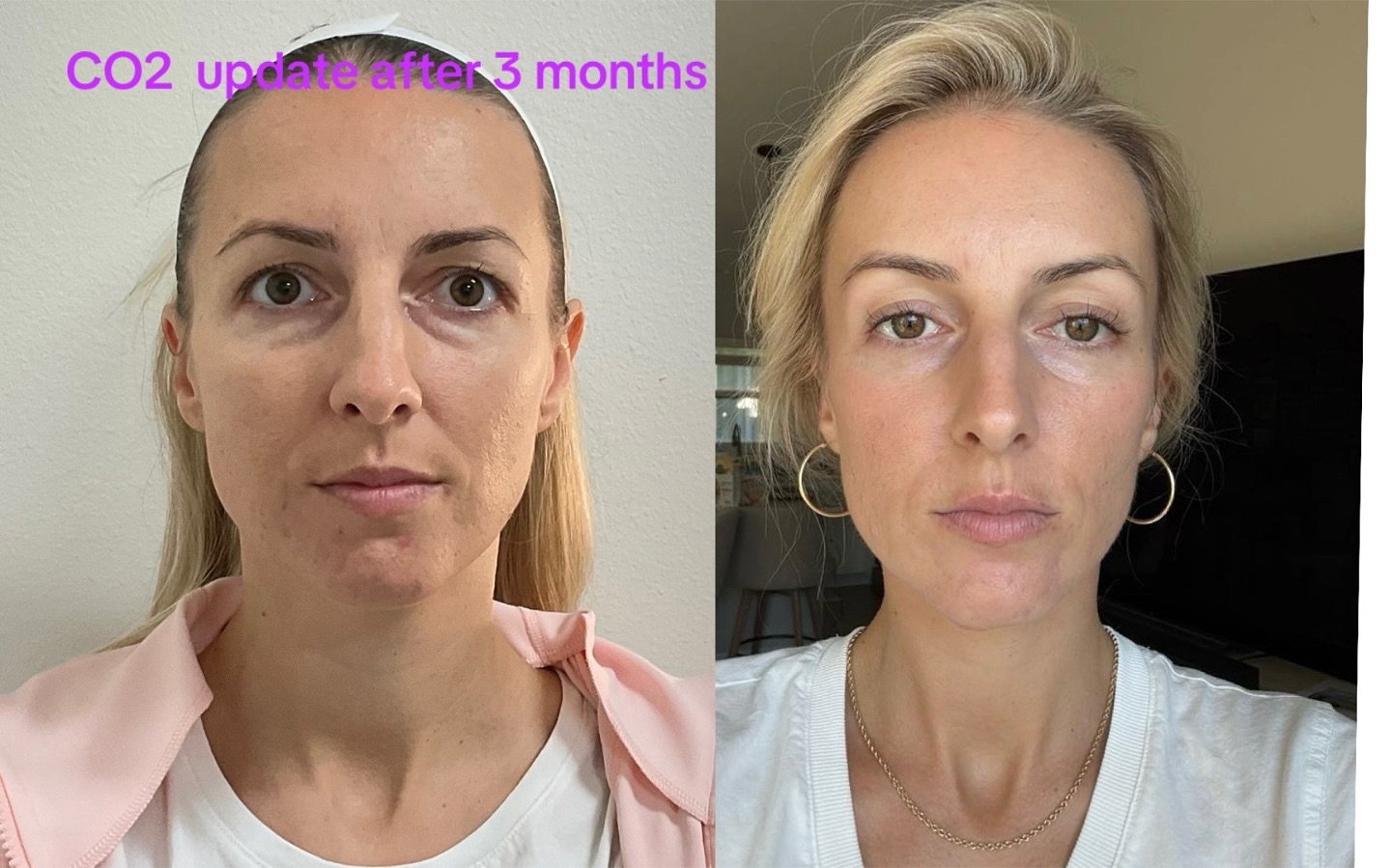 Update CO2 after 3 months #sarasota #saradotaflorida #tampa #medspaflorida #capricebeautybar #venicfl #venicflorida #miami