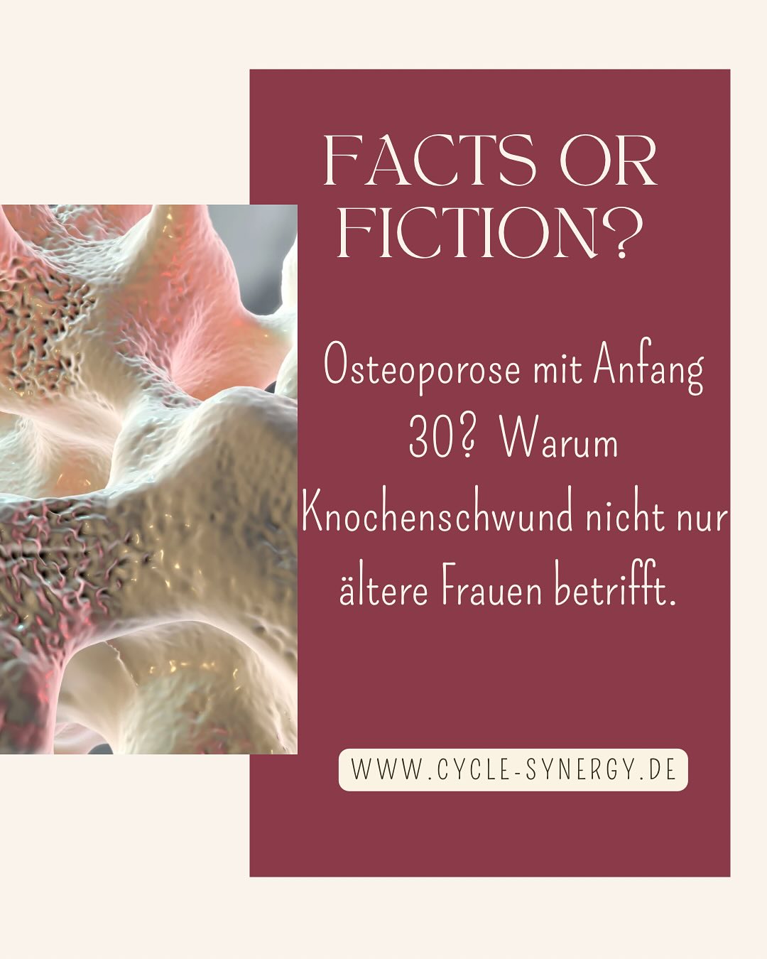 Osteoporose mit Anfang 30?
🦴 Auch junge Frauen können betroffen sein – etwa bei hypothalamischer Amenorrhoe, chronischem Stress, Schilddrüsenerkrankungen oder Essstörungen. Häufig bleibt das lange unbemerkt.
💡 Warum Hormone so wichtig sind:
– Östrogen bremst den Knochenabbau
– Progesteron fördert den Aufbau
– Testosteron stärkt die Knochendichte
– T3/T4 steuern den Stoffwechsel der Knochenzellen
Ein dauerhafter Hormonmangel kann Knochenmasse kosten!
⚠️ Die Pille ist kein Schutz: Sie unterdrückt den Eisprung, liefert kein echtes Progesteron – das Risiko für Knochenschwund bleibt.
Zur Therapie:
Herkömmliche Medikamente wie Bisphosphonate & Denosumab hemmen zwar den Knochenabbau, bauen aber nichts auf – bei jungen Frauen sind sie oft ungeeignet. Nebenwirkungen & fehlende Langzeitdaten sind ein Thema.
Was mir geholfen hat:
meinen Zyklus zurückzugewinnen, mehr Kalorien & Protein, gezielter Kraftsport, Mikronährstoffe, gute Schilddrüsenwerte (nicht einfach nur „Normwerte“).
Wichtig: Wenn du keine Periode hast oder Risikofaktoren bestehen, fordere eine Knochendichtemessung (DXA) ein. Manchmal hilft es, die Diagnose schwarz auf weiß zu haben, um ins Handeln zu kommen.
📥 Speichere diesen Post & teile ihn mit anderen Frauen, die das wissen sollten.
Quellen:
- Misra, M. et al. (2008) – Physiology of Bone Loss in Hypothalamic Amenorrhea, Journal of Bone and Mineral Research
- Bonjour, J.P. et al. (2009) – Protein Intake and Bone Health, The American Journal of Clinical Nutrition
- Hendrickson-Jack, L. (2019) – The Fifth Vital Sign
- Greger, M. (2023) – How Not to Age
- DVO-Leitlinie Osteoporose (2023) – Dachverband Osteologie e.V.
- RKI-Gesundheitsbericht (2020) – Robert Koch-Institut
#Frauengesundheit
#Zyklusgesundheit
#Hormonbalance
#Osteoporose
#Amenorrhoe
#gesundheitfürfrauen