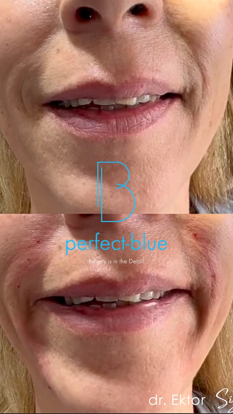 Subtle lift. Natural look.✨💁🏼♀️
💯Πιο ξεκούραστο & φρέσκο πρόσωπο σε - Βελτίωση ρινοπαρειακού αύλακα με filler
✅Zero Pain
✅Only one treatment
✅20min office procedure
🌟Μόνο @dr.ektor
👉🏻Για ραντεβού:
☎+30 210 7258982(GR)
☎+357 96 444870 (CY)
💻info@dr-ektor.com
www.dr-ektor.com
#filler #noninvasive #υαλουρονικο #symmetry #bestdoc #kolonaki #glyfada #athens#drEktor #filler #nasolabialfolds #facialfiller #naturalresults #beforeafter #athensplasticsurgeon #cyprusdoctor #aesthetictouch #subtlelift