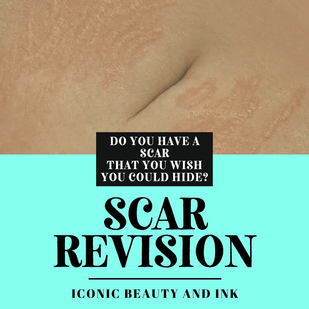๐ปReady to confidently wear any clothes or enjoy the beach without feeling self-conscious?
Introducing Inkless Stretchmark Removal - the solution you've been searching for!๐
Here at Iconic Beauty and Ink we use innovative treatments that utilize the latest technology to safely and effectively remove battle scars, without the need for invasive surgery or painful treatments.
โ
Completely safe and non-invasive process
โ
Visible results in just a few short sessions
โ
Customized treatment plan tailored to your specific needs and goals
โ
Work with trained professionals for the best results
Located at 2630 Oakland Park BlvdFt. . Lauderdale, FL 33301
Text me at 954-780-6230 now to schedule your consultation and take the first step towards achieving a more confident you or go to www.iconicbeauty andink.com to book your appointment today!
#ScarCamouflage #ParamedicalTattooing #TransformationJourney #ConfidenceBoost #ScarFreeSkin #EmbraceYourStory #BeautyBeyondScars
#browtattoo #makeupartist #coconutcreek #permanenteyeliner #permanent #browartist #microbladingartist #davie #microbladingbrows #artist #pmu #hairstrokes #micropigmentation #southflorida #oaklandpark #pompano #browgoals #eyebrow #microneedling #liptattoo #permablend #florida