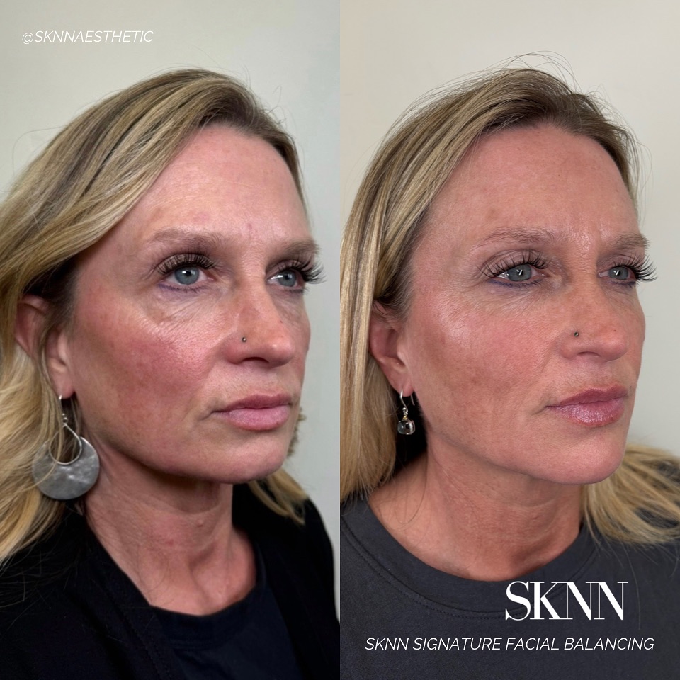 Check out these stunning 8-week results! We treated six areas using six syringes of filler to achieve this beautifully balanced, harmonious look ✨💉
Book your appointment now in our bio!
Sknn Aesthetics | Tricities Medical Spa
📍 West Pasco
#nurseinjectortricities #antiagaing #skincare #lipfillertricities #cheekfiller #chinfiller #facialbalancing #tricitieswa #pascowa #nurseinjector #medicalspa