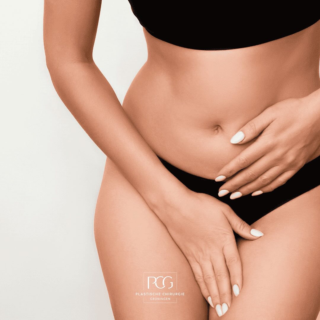 Wist je dat een labiacorrectie niet alleen cosmetisch is? Veel vrouwen kiezen hiervoor vanwege klachten zoals irritatie, pijn bij sporten of tijdens seks, of onzekerheid. 💬
Het is een kleine ingreep met vaak grote impact op comfort en zelfvertrouwen. Wil je meer informatie? Neem dan contact met ons op betreft een vrijblijvend consult!
Praat erover, informeer jezelf – jouw lijf, jouw keuze. 💕