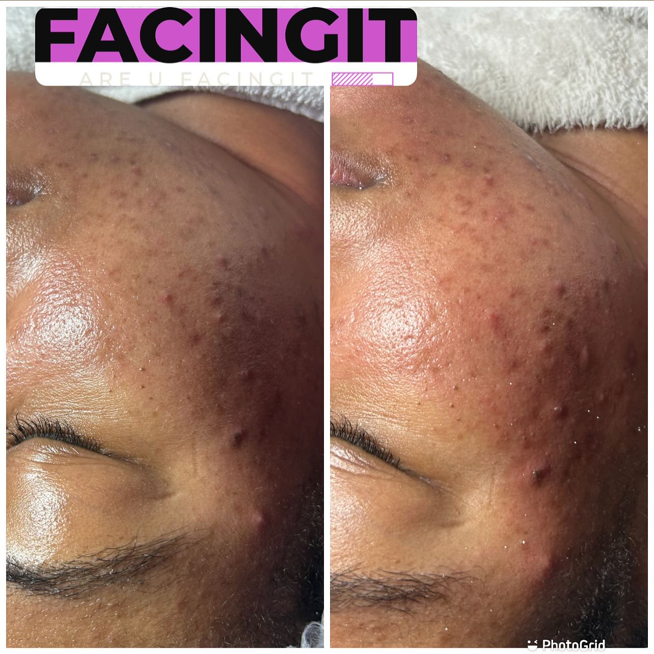 Hello! 👋🏽 My name is Aubria, and I would LOVE to be your esthetician!
I specialize in facial care and provide services that will have you coming back for more.
Did you know your skin has three layers and sheds thousands of skin cells every minute? Keeping your face clean, healthy, and smooth takes work—and finding the right products for your skin type can be overwhelming. But that’s exactly what I’m here for! 😁
Book a session with me and drift into a deep, relaxing sleep while your skin gets the rejuvenation it deserves.
✨ Check out my work and services at 👉🏽 aubriaFacingIT.com
📸 Follow me on Instagram: @_FacingIt
#facials #bodysculpting #skintightening #beauty #atlanta #laserlipo #facialsatlanta #bodygoals #cavitation #noninvasive #clarkatlanta #lipo #postoptreatment #cardi #facingit #coolsculpting #thingstodoinatlanta #woodtherapy #atlantahairstylist #radiofrequency #facialatlanta #lasorlipo #nonsurgical #vacuumtherapy #explorepage #postop #spa #atlantaga #collegepark #bodycontouringatlanta