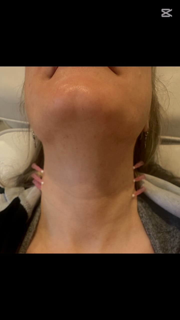 You’d think I’d be bored of them now but it’s impossible!! These threads have proven amazing results! Especially for those going through weight loss and seeing that sag creep in- cannot recommend these enough!
Definisse™ revitalise threads are the next generation of threads designed specifically for bio-stimulation and revitalisation. They promote long-lasting regeneration, added firmness and improved skin quality with a lasting glow - in both young and mature skin.
For more information contact us
www.simplyskinclinic.co.uk
#revitalisation #threads #medicallytrained #winchester #hampshire #skin #collagen #turkeyneck #weightloss #skinjourney #boost #youdoyou
@relife_aesthetics