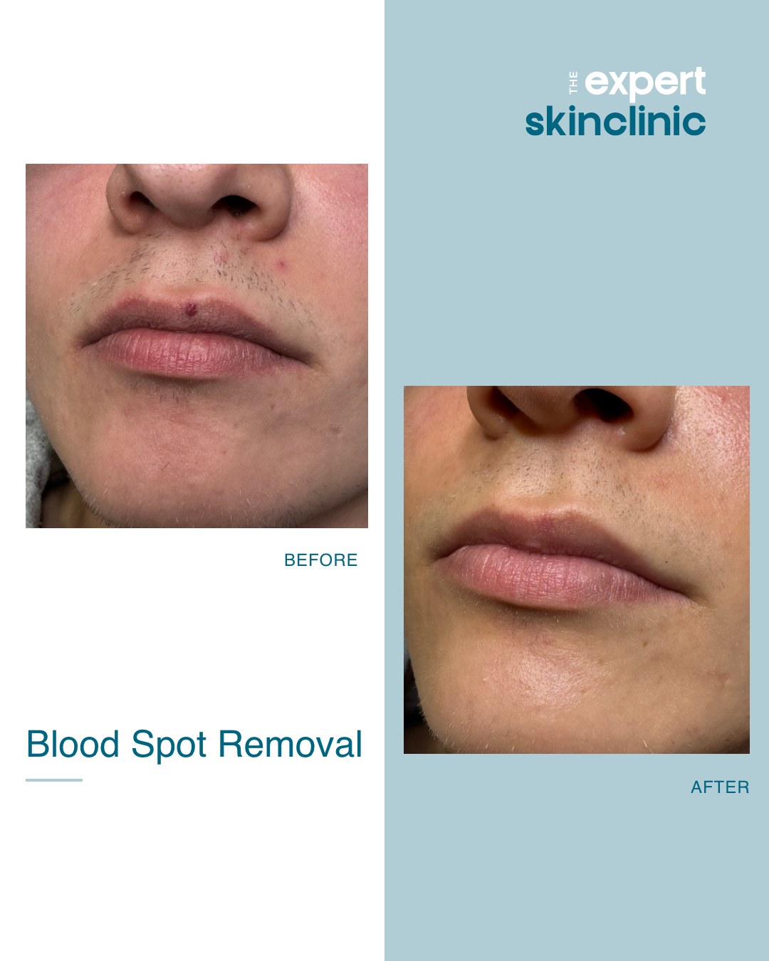 6 weeks before and after with amazing results!
We removed a blood spot from this client's lip using advanced electrolysis, and after 6 weeks, it had completely healed with no sign of the blemish.
Advanced Electrolysis offers a safe and effective way to expertly remove these blemishes, often in just one session. The spot is broken down with a heated probe from the electrolysis pen, and the body naturally heals the area, revealing clearer skin.
We're so pleased with this outcome, and so was the client! If you have a blood spot or blemish you've been considering getting removed, book a consultation on our website.
#bloodspot #bloodspotremoval #blemishremoval #advancedelectrolysis #acp