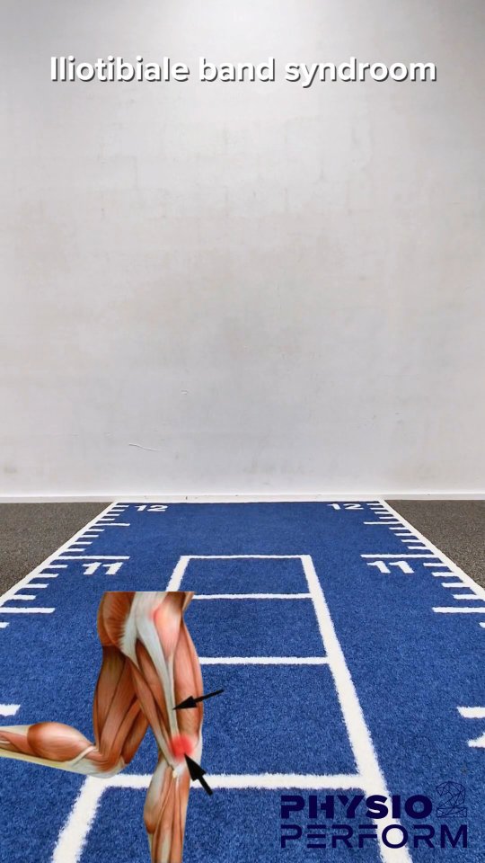 Iliotibiale band syndroom of ‘lopersknie’/‘runner’s knee’ genoemd, is een veelvoorkomende blessure bij duursporten zoals lopen en fietsen. Deze overbelastingsblessure die pijnklachten geeft aan de buitenzijde van de knie is vaak het gevolg van té gespannen spieren rondom het kniegewricht. In de eerste fase zullen we daarom ook focussen op het verminderen van spanning in deze spieren. In dit filmpje tonen we enkele oefeningen om deze knieklacht in een eerste fase aan te pakken. Kamp je met dit probleem? Maak zeker een afspraak met ons om jouw individuele aanpak uit te werken! 🏃🏻🚵🏻 #lopersknie #lopersknieblessure #runnersknee #iliotibialbandsyndrome #iliotibialband #runner #running #runninglife #marathon