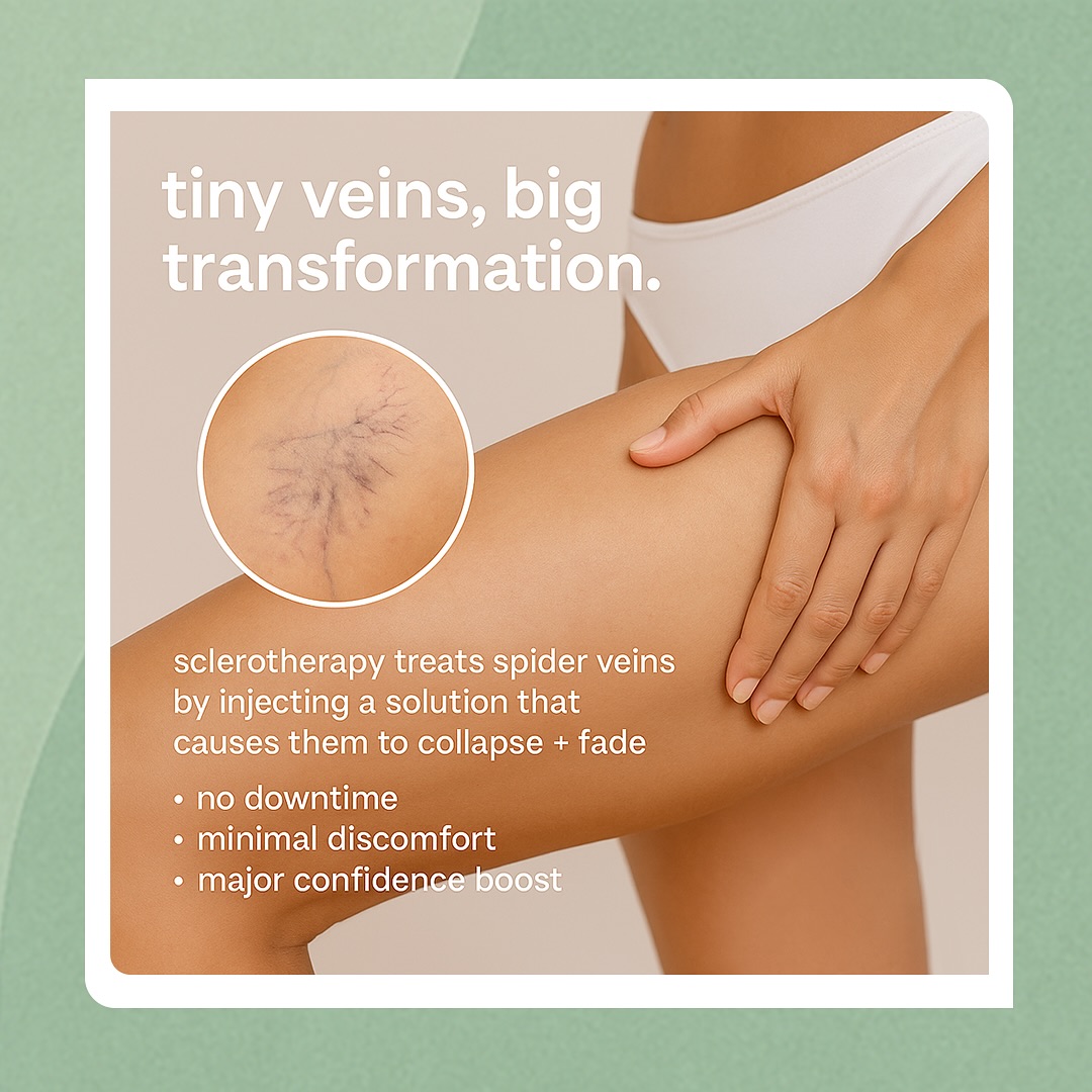 tiny veins, big transformation.
sclerotherapy treats spider veins by injecting a solution that causes them to collapse + fade.
• no downtime
• minimal discomfort
• major confidence boost
whether it’s legs, ankles, or behind the knees — we can help you feel good in your skin again.
📍 weston, fl
💉 walk in, walk out, no more visible veins
📱 book your appointment today
➡️ indehealth.com
#sclerotherapy #spiderveins #vein #removal #inde #health #weston #florida #aesthetic #confident #skin
