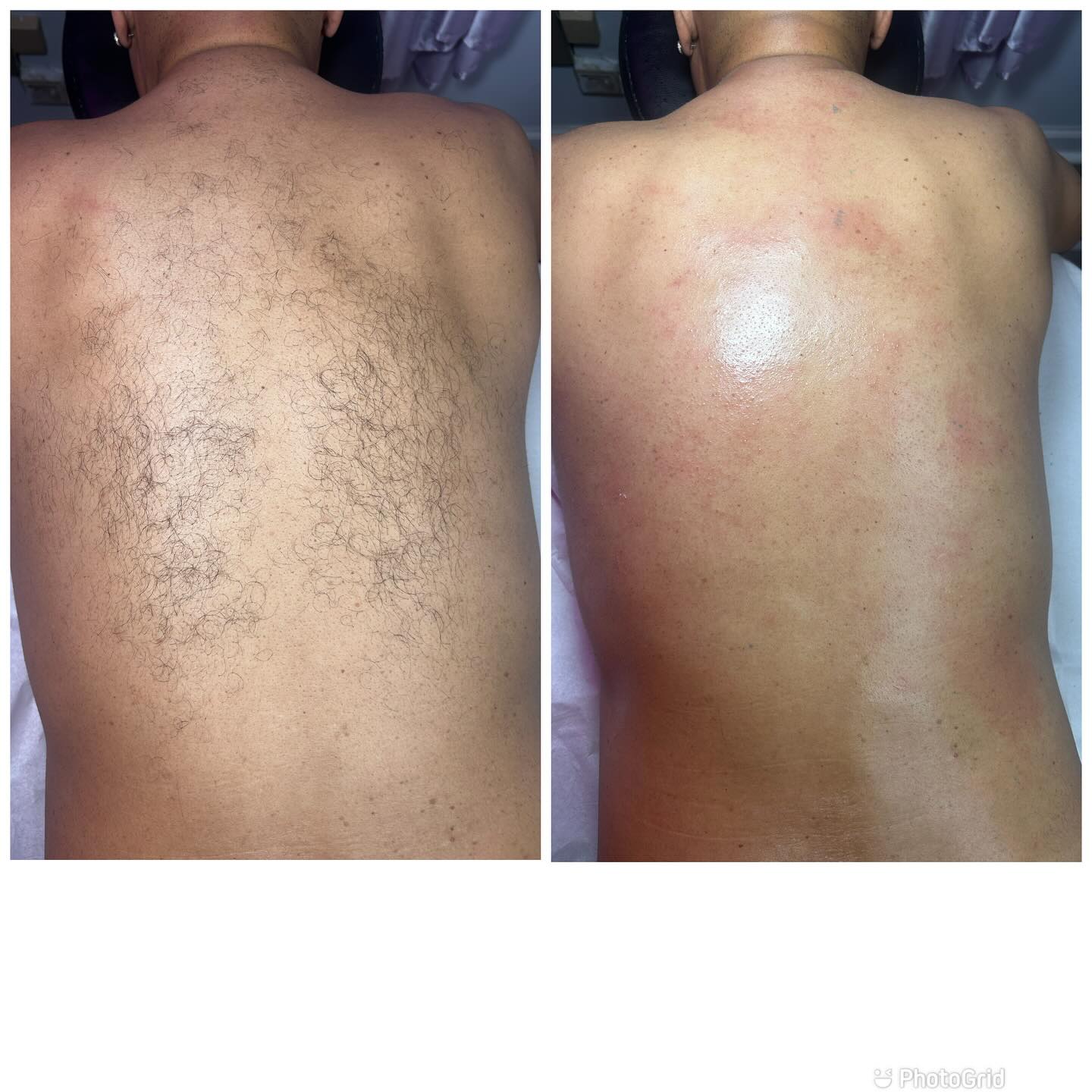 Men back wax
#waxspecialist #bodywax #waxingspecialist #legwaxing #eyebrowwax #facialwaxing #browwaxing #fullbodywaxing #facials #bodywaxing #Atlantawax #Atlwax #fyp #explorepage #bodycontouring #Bodysculpting #atl #Atlanta #Facial #facials#Foryoupage #Waxing #waxatlanta #Waxatl
Waxing is a temporary hair removal process that involves applying wax directly to the skin and then removing the hair and wax all at once. What is a Brazilian wax? A Brazilian wax is a waxing service that completely removes pubic hair from the front, upper thighs, and butt. Based on your personal preference, you can leave a small strip of hair, a triangle, or square on the front.