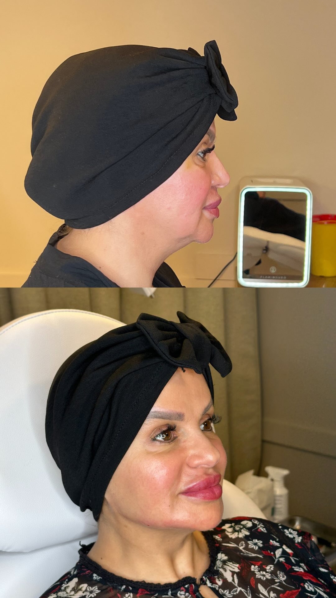 Patiente avec manque de définition au niveau de l’ovale du visage (jawline) + joues tombantes.
Nous avons donc travaillé cela pour un résultat magnifique.
Vous ne devinerez jamais son âge 🤫
Résultat 10 ans de gagnés et une patiente aux anges.