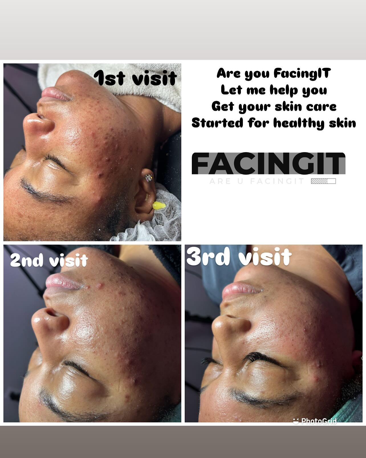 Get you a esthetician that will show you results. Every session !! Dermaplaning is a skin treatment that uses an exfoliating blade to skim dead skin cells and hair from your face.Dermaplaning aims to make your skin’s surface smooth, youthful, and radiant. This treatment can aim to remove deep scarring from acne and uneven skin tone on your skin. It’s also used to remove “peach fuzz,” the short, soft hairs on your face.
Benefits Of Facials
* Reduce Stress And Relieve Psychological Distress.
* Cleanse Your Skin.
* Prevent Aging. ...
* Facial Massage Promotes Blood Circulation. ...
* Rejuvenate Your Skin. ...
* Facials Help Detoxify The Skin. ...
* Treat Acne And Acne Marks. ...
* Eliminate Whiteheads And Blackheads.
Follow my business page @_FacingIt & check out some of my work
Website: AubriaFacingIT.com
Are You FacingIT
