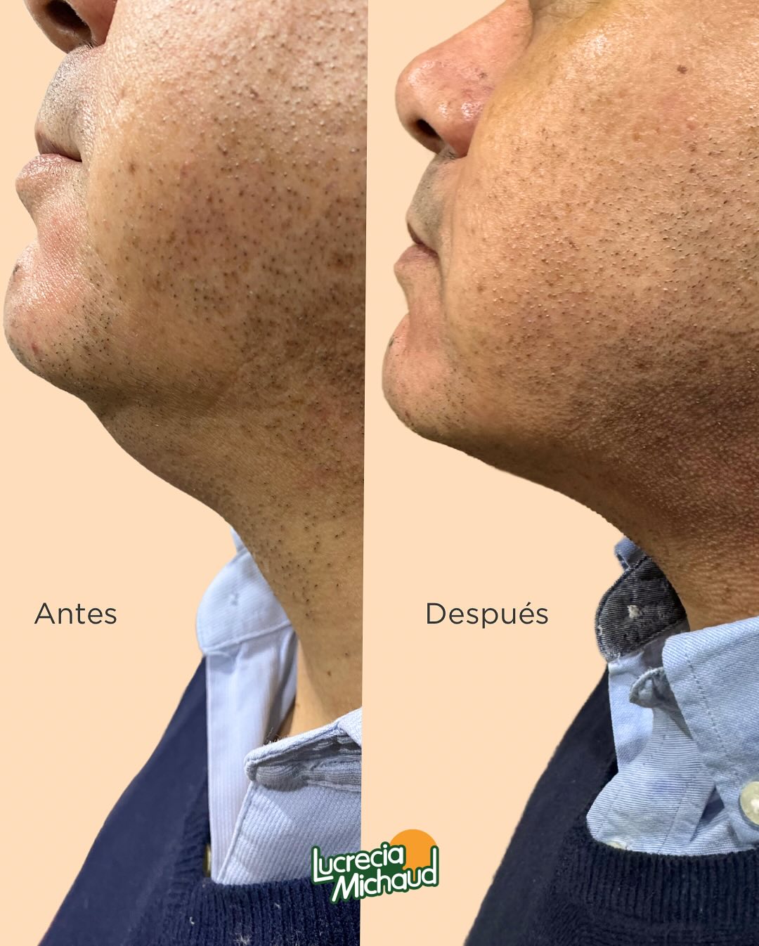 ✨ Reducción de Papada y Rejuvenecimiento Facial Masculino ✨
Resultados reales tras un protocolo personalizado de 1 mes
🔹 2 sesiones de HIFU (Ultrasonido Focalizado de Alta Intensidad)
Estimula colágeno en profundidad, tensa la piel y mejora el contorno facial.
🔹 3 sesiones de Ultrasonido con Cavitación
Ayuda a disolver grasa localizada bajo el mentón de forma no invasiva.
🔹 Mesoterapia con Fosfatidilcolina
Reduce la adiposidad localizada y mejora la textura cutánea.
💡 Ideal para quienes buscan un rostro más definido y juvenil sin necesidad de cirugía.
📸 Mira la diferencia en solo semanas: piel más firme, menos volumen en papada y una apariencia visiblemente más rejuvenecida.
📍Vitacura 9910, Santiago
🚗 Estacionamiento Amplio y privado
#RejuvenecimientoFacial #ReducciónDePapada #LucreciaMichaud #TratamientosNoInvasivos #HIFU #CavitaciónEstética #EstéticaFacialHombre #vitacura