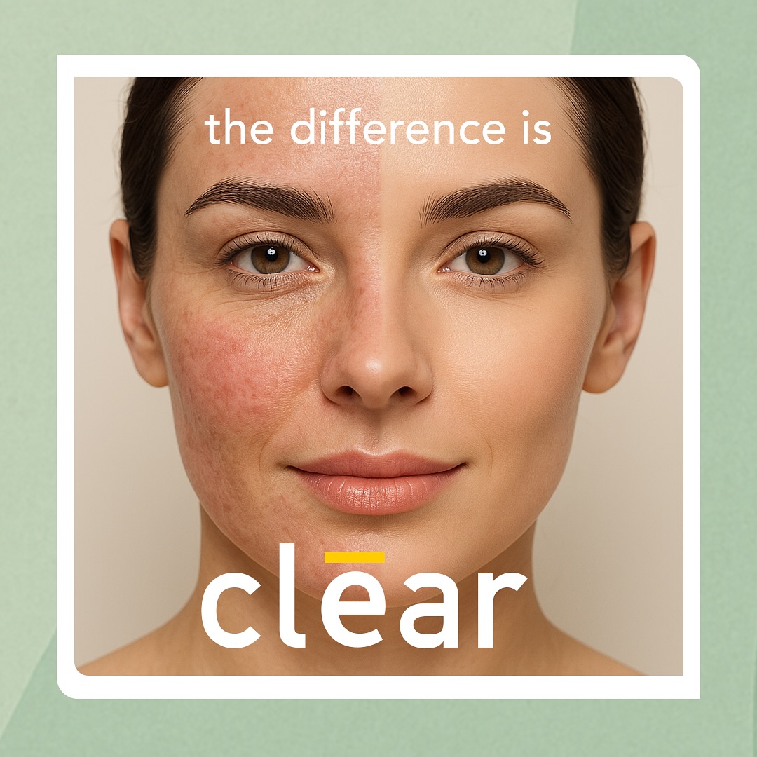 ✨ smooth, glowing skin starts below the surface.
meet SkinPen® — the first FDA-cleared microneedling device trusted by dermatologists & now available at indē health.
🧬 stimulates collagen + elastin
🌟 improves texture, tone + firmness
💫 minimizes fine lines, scars + large pores
🩹 minimal downtime, maximum results
📍 weston, fl
📦 book your treatment today
🧪 optional add-ons: PRP, peptide serums, growth factors
💉 performed by skilled professionals with sterile, medical-grade precision
➡️ www.indehealth.com
#skinpen #microneedling #collagen #therapy #glowing #skin #skincareroutine #weston #inde #health #aesthetic #wellness #smoothskin #wrinkle #reduction #prp #antiaging