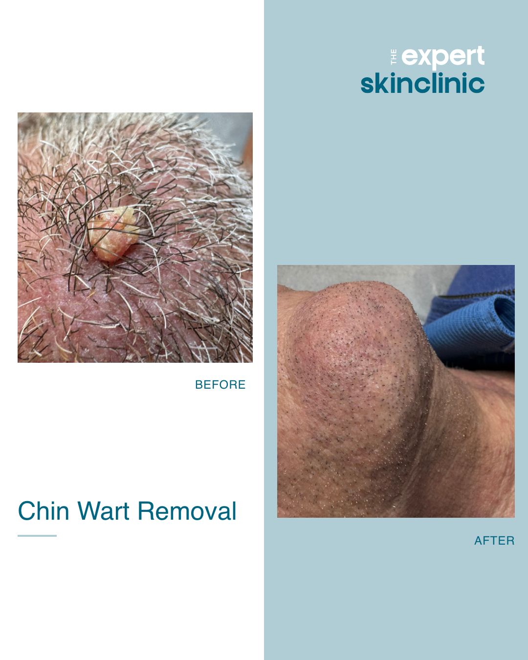 Amazing results from a recent chin wart removal!
This chin wart removal is a fantastic examples of the power of advanced electrolysis! We achieved these results after just one targeted treatment, with the blemish completely gone after just 6 weeks.
We specialise in safe and effective wart removal, to help you regain your confidence✨
If you're looking for wart removal in Northampton, book a consultation at our new premises within Dallington Fitness.
#wartremoval #advancedelectrolysis #skintranformation #skinclinic #northamptonskin