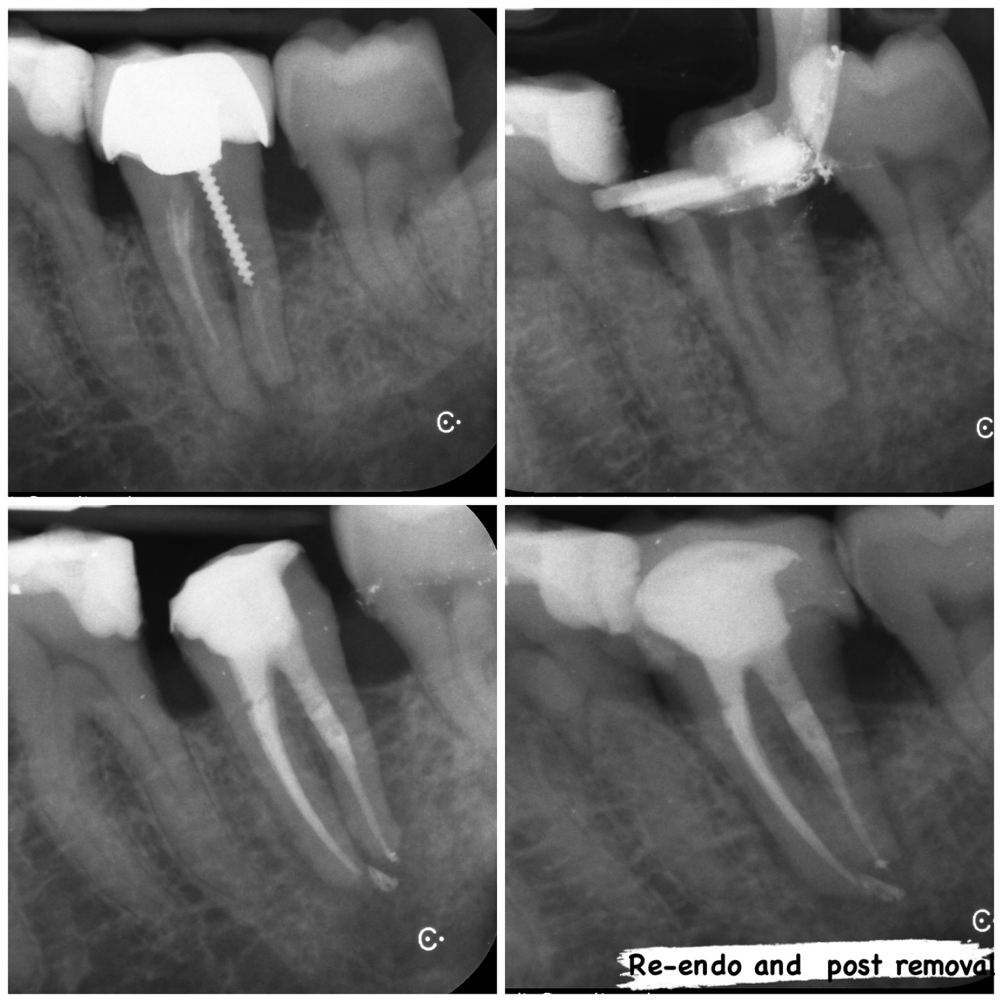 LL7 re-treat with disassembly and post removal. 3 canals 2 POEs. #nhs #treat #treatment #endowarrior #endodontia #rootcanaltreatment #rootcanaltherapy #endobelly #waves #waveonegold #saveteeth #endospecialist #treatyourself #simplicity #dentaltreatment #compositebonding #dentistry #endodontics #dentaltreatment #difficultendo #dentistrylife #reendo #postremoval