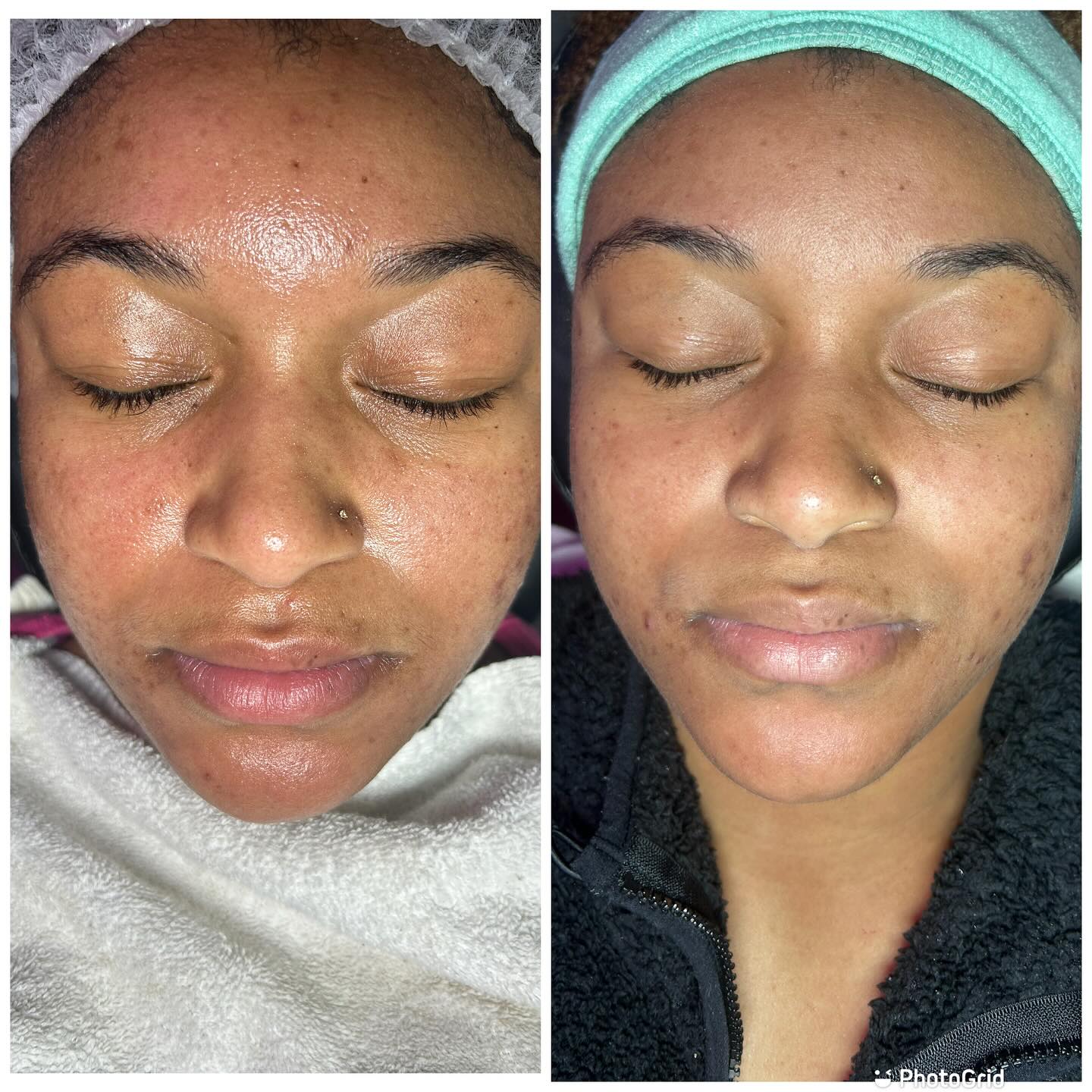 Hello! 👋🏽 My name is Aubria, and I would LOVE to be your esthetician!
I specialize in facial care and provide services that will have you coming back for more.
Did you know your skin has three layers and sheds thousands of skin cells every minute? Keeping your face clean, healthy, and smooth takes work—and finding the right products for your skin type can be overwhelming. But that’s exactly what I’m here for! 😁
Book a session with me and drift into a deep, relaxing sleep while your skin gets the rejuvenation it deserves.
✨ Check out my work and services at 👉🏽 aubriaFacingIT.com
📸 Follow me on Instagram: @_FacingIt
#facials #bodysculpting #skintightening #beauty #atlanta #laserlipo #facialsatlanta #bodygoals #cavitation #noninvasive #clarkatlanta #lipo #postoptreatment #cardi #facingit #coolsculpting #thingstodoinatlanta #woodtherapy #atlantahairstylist #radiofrequency #facialatlanta #lasorlipo #nonsurgical #vacuumtherapy #explorepage #postop #spa #atlantaga #collegepark #bodycontouringatlanta