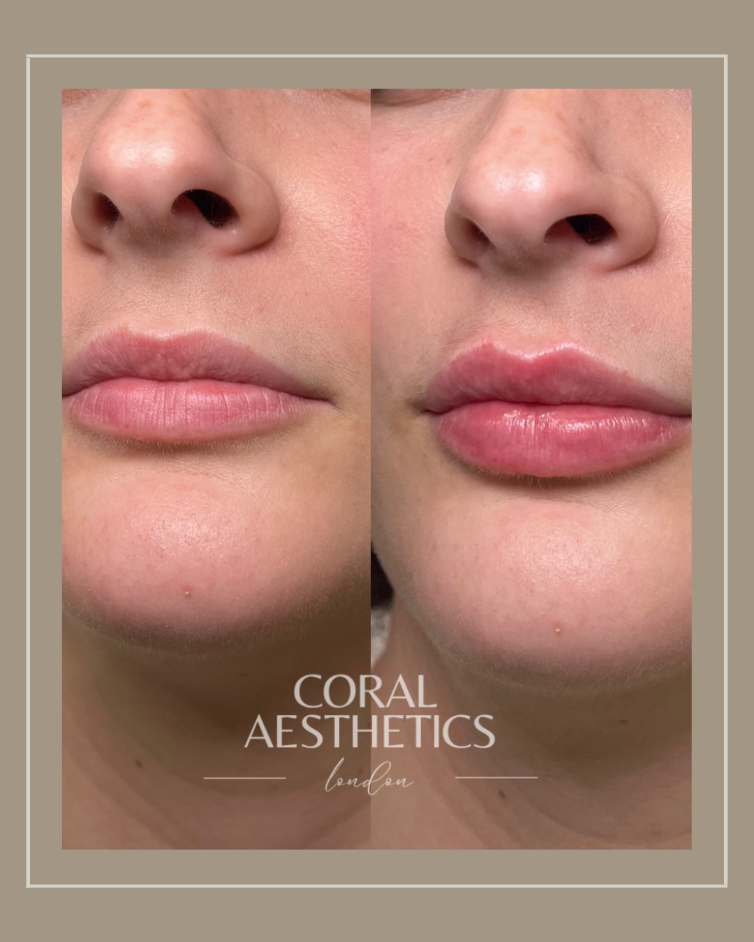 Let’s talk lip goals ...
Not everyone walks into the clinic wanting the same thing - and that’s exactly why every treatment is tailored to you.
Some clients want more volume.
Some just want balance or to smooth out fine lines.
Others want to restore what’s been lost over time.
This lovely client wanted a subtle, hydrated look that kept her natural shape, and we're obsessed with the results!
💉 Soft, balanced, and completely her.
Because lip filler isn’t one-size-fits-all - it’s personal.
📩 Thinking about lip filler? DM us to chat with Nurse Coral or book your consultation.