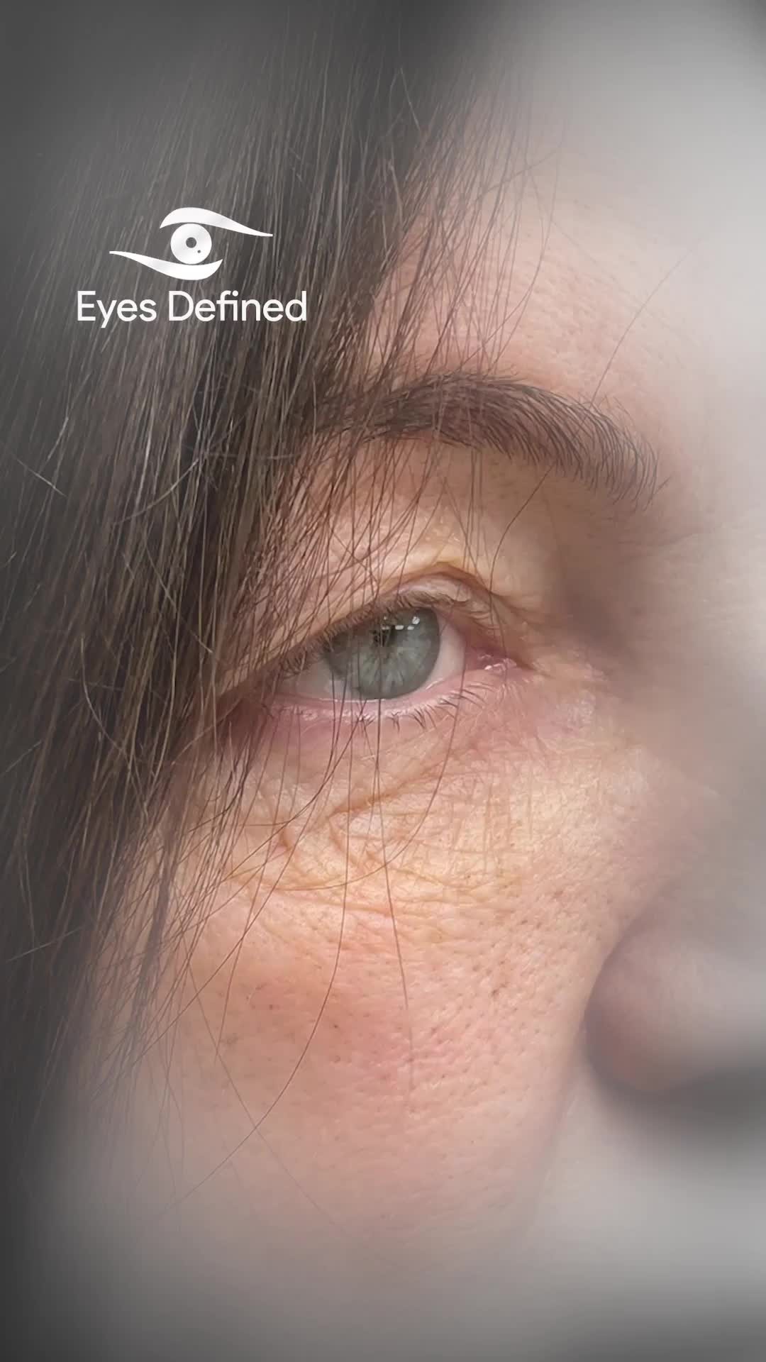 A subtle yet powerful transformation — reducing upper eyelid hooding to restore a more refreshed, open-eyed appearance.
Performed with precision and an artistic eye for natural results.
📍 London | Oculoplastic Surgeon
📩 DM to book a consultation
#UpperEyelidBlepharoplasty #BlepharoplastyLondon #EyelidSurgery #OculoplasticSurgeon #FacialAesthetics #LondonAesthetics #EyelidRejuvenation #NaturalResults #EyelidLift #BeforeAndAfter #EyeMakeover #AestheticSurgery #RefreshYourLook