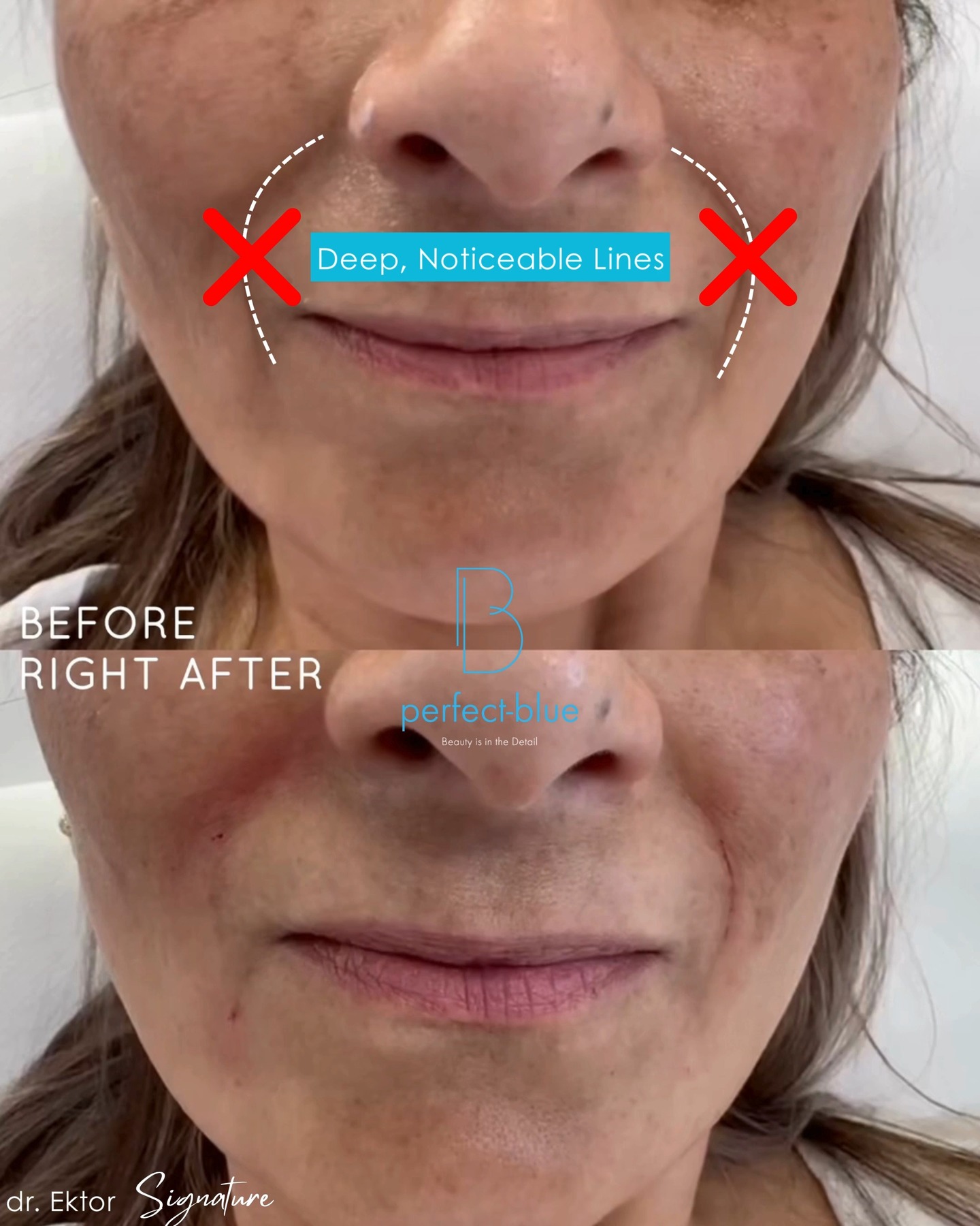✨Softened smile lines✨
Using expert technique, Dr. Ektor gently reduces deep nasolabial folds, giving you a refreshed, well-rested look.
✔️ Immediate smoothing of deep lines
✔️ Fresher, revitalized look
✔️ Natural results that blend perfectly
✔️ Minimal downtime
✔️ Long-lasting facial harmony
✨ Only @dr.ektor
📲 Book your appointment:
📞 GR: +30 210 725 8982
📞 CY: +357 96 444 870
📧 info@perfect-blue.com
🌐 www.dr-ektor.com