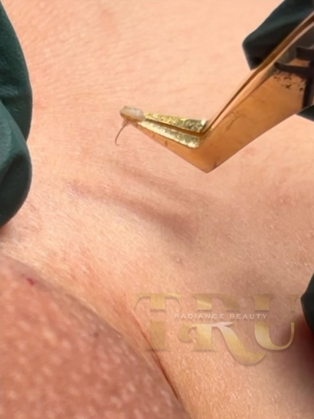 Fishing for these ingrowns! I love this clients cause she always need extractions since she don’t exfoliate lol She just coped The Evolv Exfoliator Serum so I’m hoping it’s used so we can see a difference 🤞🏽#cincinnatiesthetician #fyp