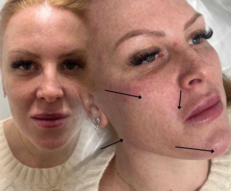 โจ Look at this STUNNING transformation! โจ
This beautiful girl visited The Beauty Lab North East for 4mls of expertly placed dermal filler โ and the results speak for themselves! ๐
๐ Hereโs where her filler was placed:
โข 0.5ml in each cheek for that natural lift
โข 0.5ml in each nasolabial fold to soften smile lines
โข 1ml in the chin for definition and balance
โข 0.5ml each side of the jaw for a snatched, contoured look
The result? Uplifted. Fresh. Beautiful. ๐ซ
Ready for your own subtle yet stunning transformation? Message us to book your consultation today!
#TheBeautyLabNorthEast #DermalFiller #CheekFiller #ChinFiller #JawlineGoals #FreshFace #BeautyEnhancement #aestheticsuk