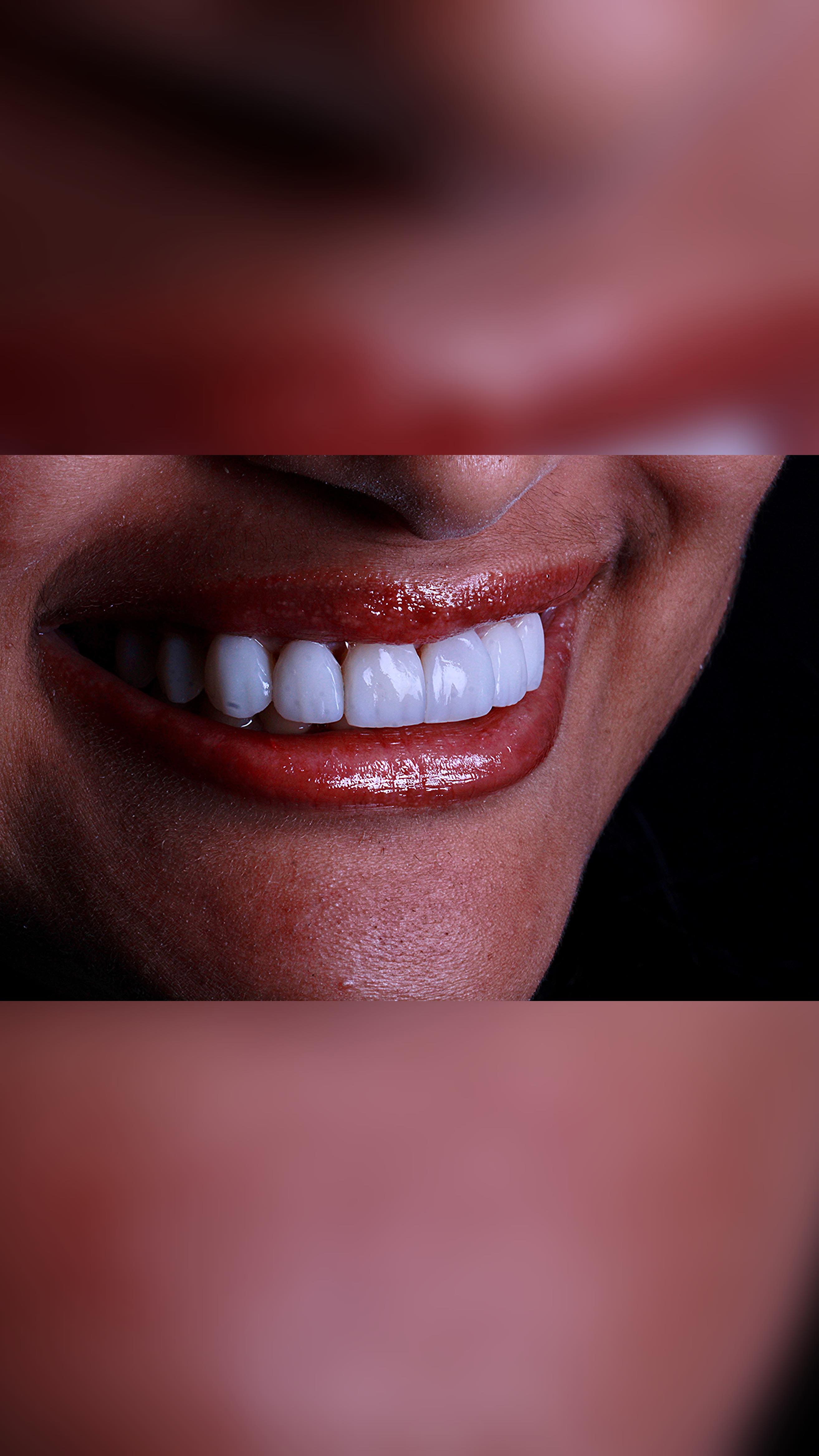 A nossa alegria como profissional é ver o paciente realizado ao se olhar no espelho após sua transformação!#OdontologiaEstética #Zircônia #zibase #ImplantesDentários #PróteseSobreImplante #Dentista#facetas #lentes #implantes #saudebucal #odontologia #tratamentoodontologico #dente #estetica #anapolis #implantezirconia #odontologiabiológica #odontolgiaintegral #odontologiabiologicaeintegrativa #dentistaanapolis #scannerintraoral