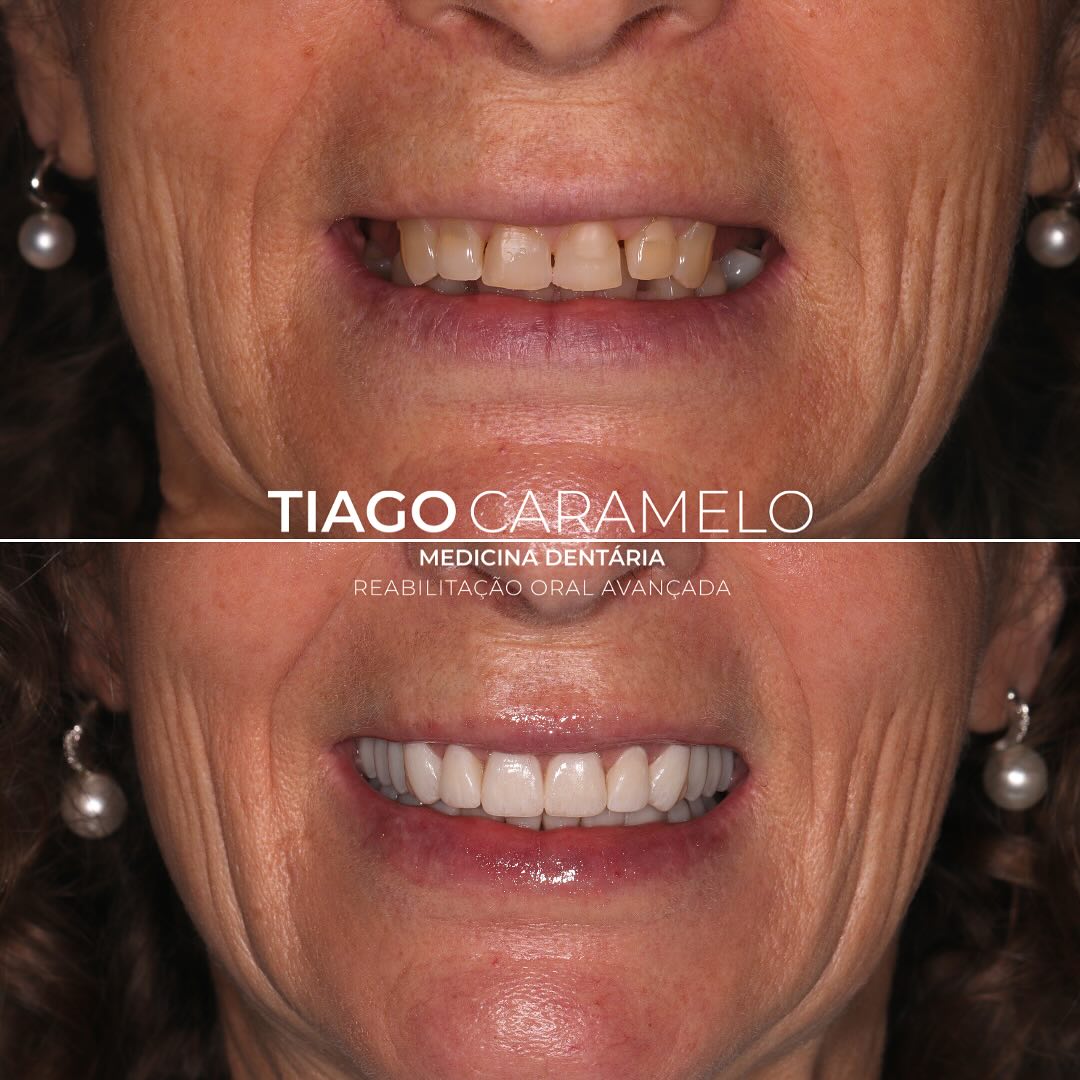 Este caso representa aquilo que me apaixona na medicina dentária: a capacidade de transformar, de reconstruir, de devolver aquilo que o tempo, o desgaste e a ausência dentária foram retirando — não apenas a função mastigatória, mas a confiança, a autoestima e o prazer de sorrir sem medo.
Através de um plano de tratamento completo e individualizado, recorremos a:
🔹 Coroas sobre dentes
🔹 Implantes e coroas sobre implantes
🔹 Facetas
Todo o trabalho foi orientado por um único objetivo: devolver naturalidade, harmonia e equilíbrio ao sorriso da paciente, respeitando sempre a sua expressão individual.
Mais do que estética, tratou-se de devolver funcionalidade, saúde oral e sobretudo qualidade de vida.
Hoje, a paciente sorri com confiança, com orgulho e sem reservas — e isso é, para mim, a maior recompensa.
Um sorriso que renasce, uma vida que muda
Trabalho cirúrgico realizado por @dr.armandolopes
Trabalho de suporte periodontal realizado por @ggparreira
Trabalho laboratorial realizado por @alldinafmoreirah e @deniseoliveira2238
—————————————————————————————
This case embodies what truly inspires me in dentistry: the ability to transform, to rebuild, and to restore what time, wear, and tooth loss have taken away — not just the ability to chew, but also confidence, self-esteem, and the joy of smiling without fear.
Through a fully personalised and comprehensive treatment plan, we carried out:
🔹 Crowns on natural teeth
🔹 Implants and implant-supported crowns
🔹 Veneers
Every step of this work was guided by a single goal: to restore the natural look, harmony, and balance of the patient’s smile, always respecting her unique facial expression.
More than aesthetics, this was about restoring function, oral health, and — above all — quality of life.
Today, this patient smiles with confidence, pride, and freedom — and that, to me, is the greatest reward.
A smile reborn. A life transformed.
Surgical work by @dr.armandolopes
Periodontal support by @ggparreira
Laboratory work by @alldinafmoreirah and @deniseoliveira2238
#oralrehabilitation #ceramicveneers #ceramiccrowns #beforeandafter #oralrehabilitation #nobelbiocare