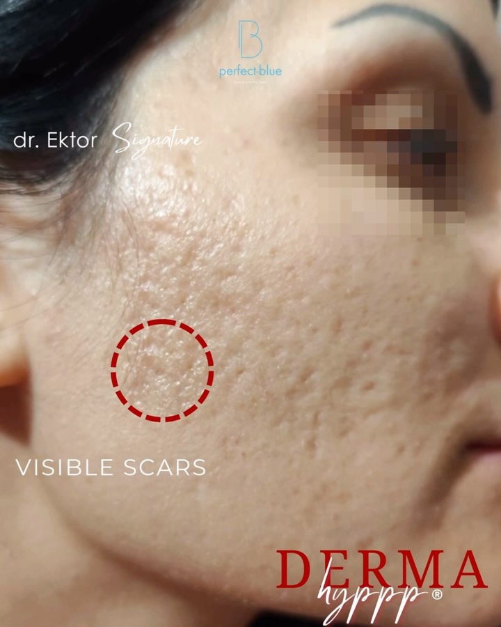 ✨ From scars to confidence! ✨3 month Result after Derma Hyppp® Treatment
💯Years of acne scars — now replaced by smooth, radiant, firmer skin. 💫
Derma Hyppp®, Dr. Ektor’s signature protocol, combines premium techniques for real, long-lasting skin transformation. No filters — just results. 💖
✨ Only @dr.ektor
📲 Book your appointment:
📞 GR: +30 210 725 8982
📞 CY: +357 96 444 870
📧 info@perfect-blue.com
🌐 www.dr-ektor.com
#DermaHyppp #AcneScars #SkinTransformation #NoMoreFilters #SmoothSkinJourney #ConfidenceInYourSkin #DrEktor #SignatureProtocol #PremiumSkinCare #Kolonaki #Limassol #Greece #Cyprus #GlowingSkin #SkinGoals