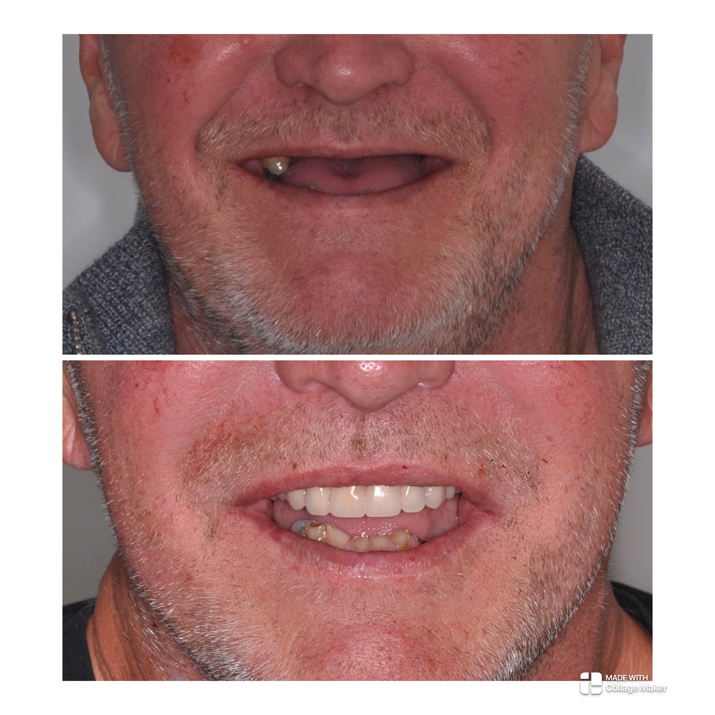 All on 4 with immediate load today. @sarah_osstemuk #allonfour #dentalimplants #immediateloadingimplants #osstemimplants @shahid.chawoo