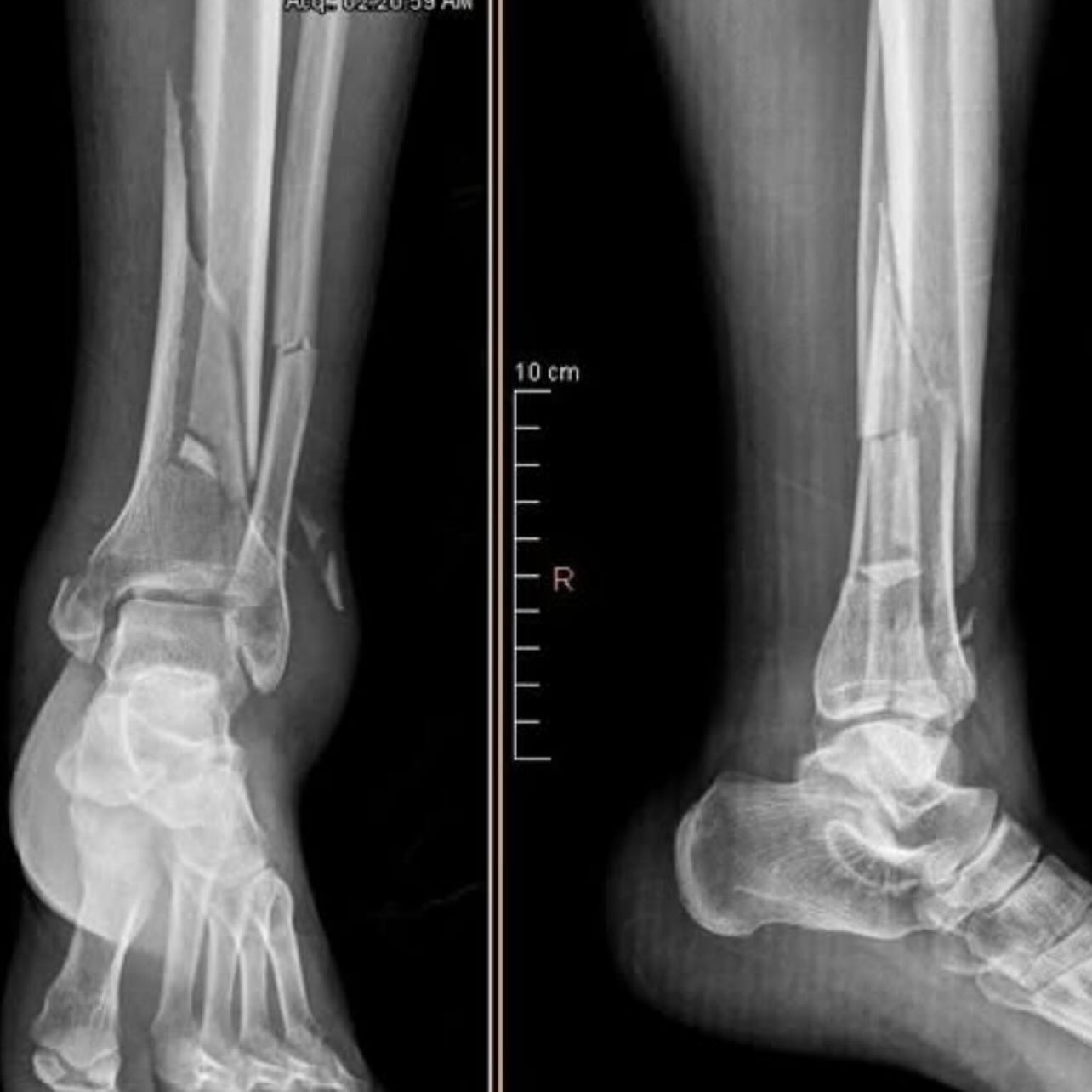 Las fracturas de pilón tibial son debido a caídas de gran altura donde el astrágalo actúa como un pilón o martillo disipando la energía sobre la tibia, lo que compromete de manera importante la superficie articular, la estabilidad del hueso e incluso un daño grave de los tejidos blandos, su tratamiento siempre será quirúrgico para aminorar las complicaciones que se deriven de este traumatismo.
#pilóntibial #fracturadetibia #cirugiadepieytobillo