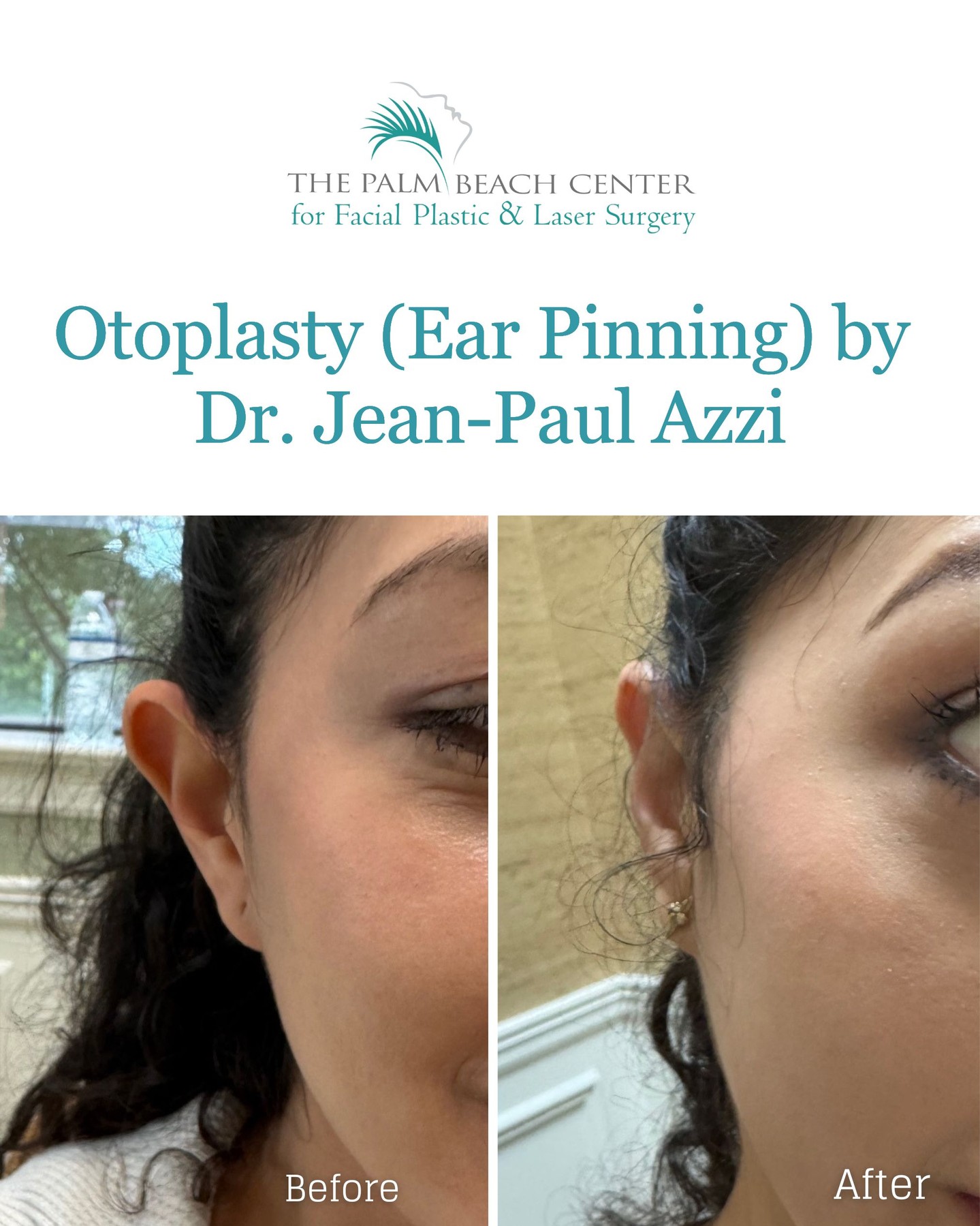 Otoplasty is a minimally invasive ear pinning procedure performed right here in our office without general anesthesia. By reshaping and repositioning the ears closer to the head, Dr. Azzi achieved a natural, balanced look that beautifully complements her facial features. The results are subtle but life-changing, especially for patients who’ve long felt self-conscious about prominent ears.
Interested in learning more? Schedule a consultation today and discover how otoplasty can boost confidence at any age. Call (561) 429-5403 or request a consult on our website (link in bio).
#Otoplasty #EarPinning #DrAzzi #JupiterFlorida #PalmCity #PalmBeachGardens #StuartFL #PalmBeachLife #westpalmbeachfl #ilovewpb #DrAzzi #FacialPlasticSurgery #PalmBeachPlasticSurgeon