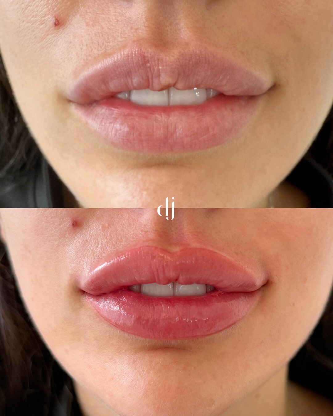 Some recent Lip Blush results in clinic
The difference lip blush makes gives the whole face a lift. Perfecting shape, colour and contour
Our booking system is now live
www.daniellejamesclinic.co.uk
0151 329 3110
#lipblushing #lipblushtattoo #lipblushtraining #lipblush