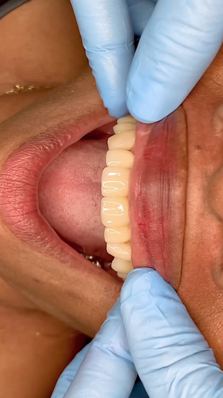 #OdontologiaEstética #Zircônia #zibase #ImplantesDentários #PróteseSobreImplante #Dentista#facetas #lentes #implantes #saudebucal #odontologia #tratamentoodontologico #dente #estetica #anapolis #implantezirconia #odontologiabiológica #odontolgiaintegral #odontologiabiologicaeintegrativa #dentistaanapolis #scannerintraoral