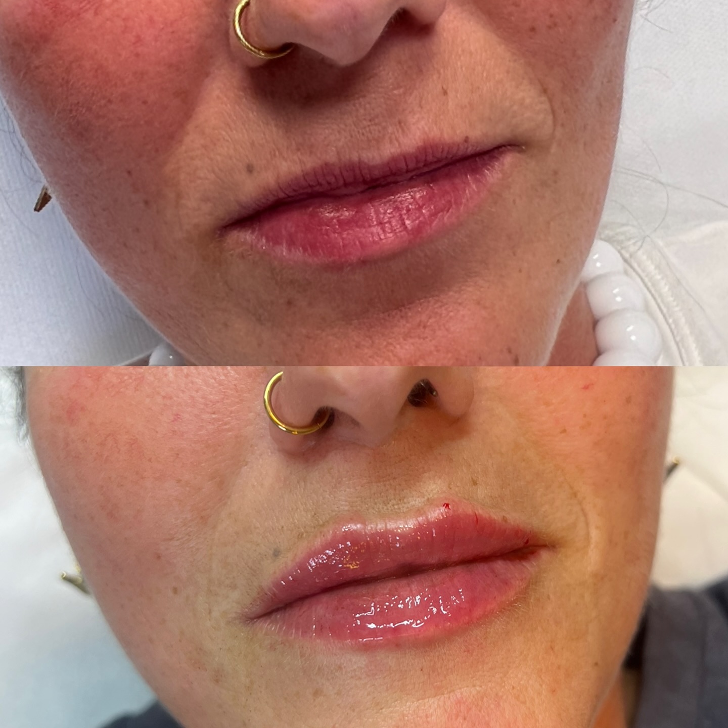 Lips 1ML travaillées en 2fois, résultat magnifique pas de migration tout en subtilité 😍😍😍