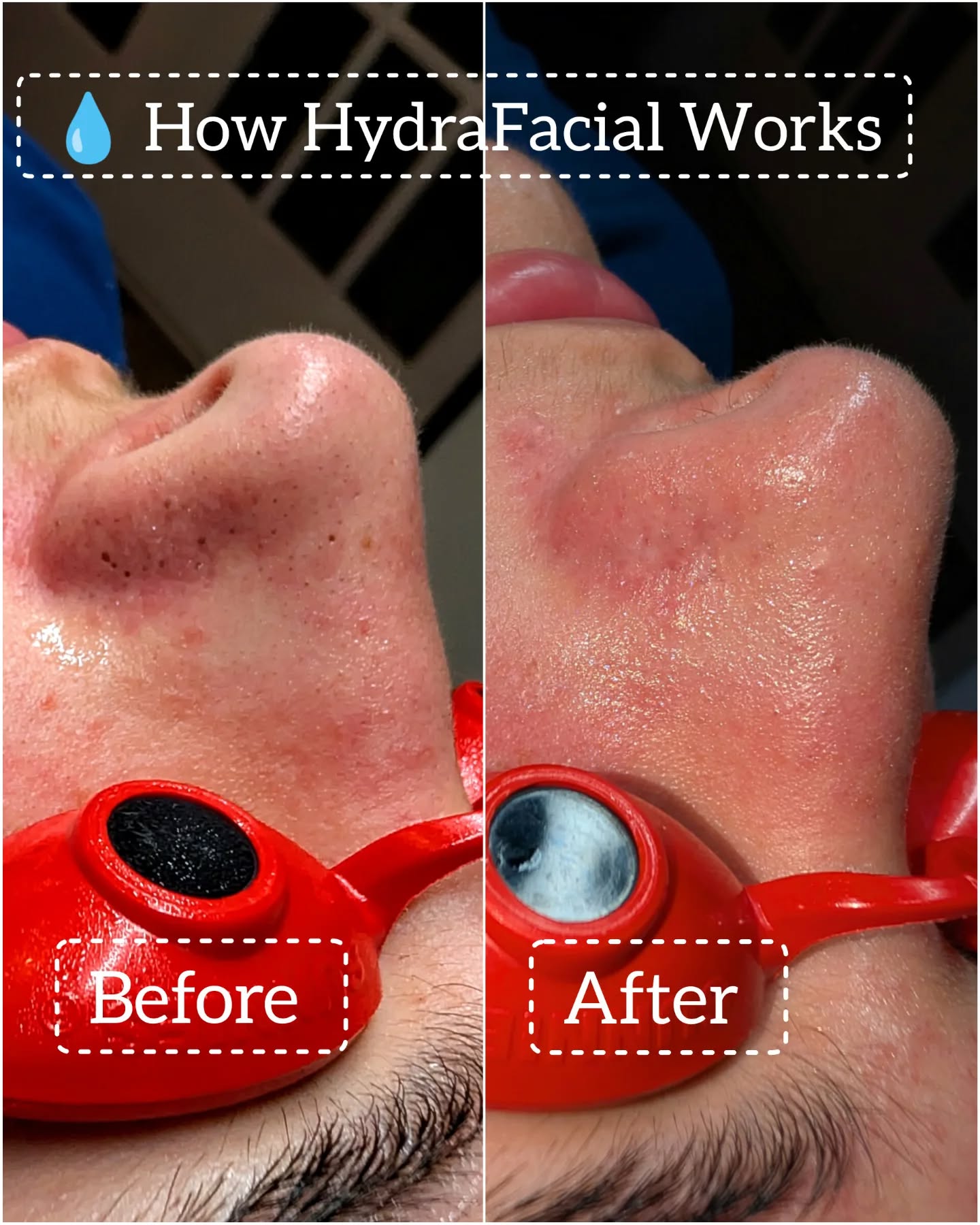 The result?
Smooth, clean, hydrated, and glowing skin — with zero downtime! Perfect before a big event or as monthly skincare maintenance.
HydraFacial is a non-invasive skincare treatment that cleanses, exfoliates, extracts, and hydrates the skin — all in one session. Here’s how it works step-by-step:
Cleanse & Exfoliate
Removes dead skin cells and surface buildup to reveal a fresh new layer of skin.
Gentle Acid Peel
A mix of glycolic and salicylic acid loosens dirt and debris from pores without irritation.
Vacuum Extraction (The Junk Jar!)
A painless suction tool clears out blackheads, oil, and impurities — everything goes into the “junk jar” so you can see the results!
Hydration & Serum Infusion
Powerful hydrating serums with antioxidants, peptides, and hyaluronic acid are infused deep into the skin to plump, protect, and glow.
#HydraFacial
#HydraFacialGlow
#HydraFacialResults
#HydraFacialTreatment
#HydraFacialBeforeAndAfter
#HydraFacialCentennial
#HydraFacialColorado
#JunkJarSatisfaction
#GlowWithHydraFacial
#DeepCleanSkin
#GlowingSkin
#SkincareThatWorks
#HealthySkinJourney
#FacialTreatment
#SkincareGlowUp
#ClearSkinGoals
#YouthfulSkin
#SkinHydration
#GlassSkinGoals
#lno_boutique