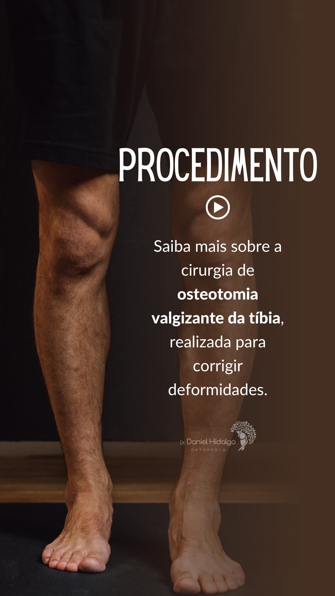 A cirurgia de #osteotomia valgizante da tíbia 🦴 é usada para corrigir deformidades do joelho. Confira!
#joelho
#ortopedia
#ortopedista
#ligamentocruzadoanterior
#ligamentocruzadoposterior
#ligamentocolateralmedial
#ligamentocolaterallateral
#menisco
#patela
#cirurgiadojoelho
#drdanielhidalgo
#artroscopia
#jardins
#altodepinheiros
#alphaville
#alphavilleearredores
#klabin
#saopaulo
Dr. Daniel Hidalgo - Médico Ortopedista
CRM-SP 137.057 | RQE 41.112
Membro da Sociedade Brasileira de Ortopedia e Traumatologia (SBOT)
Membro da Sociedade Brasileira de Cirurgia do Joelho (SBCJ)