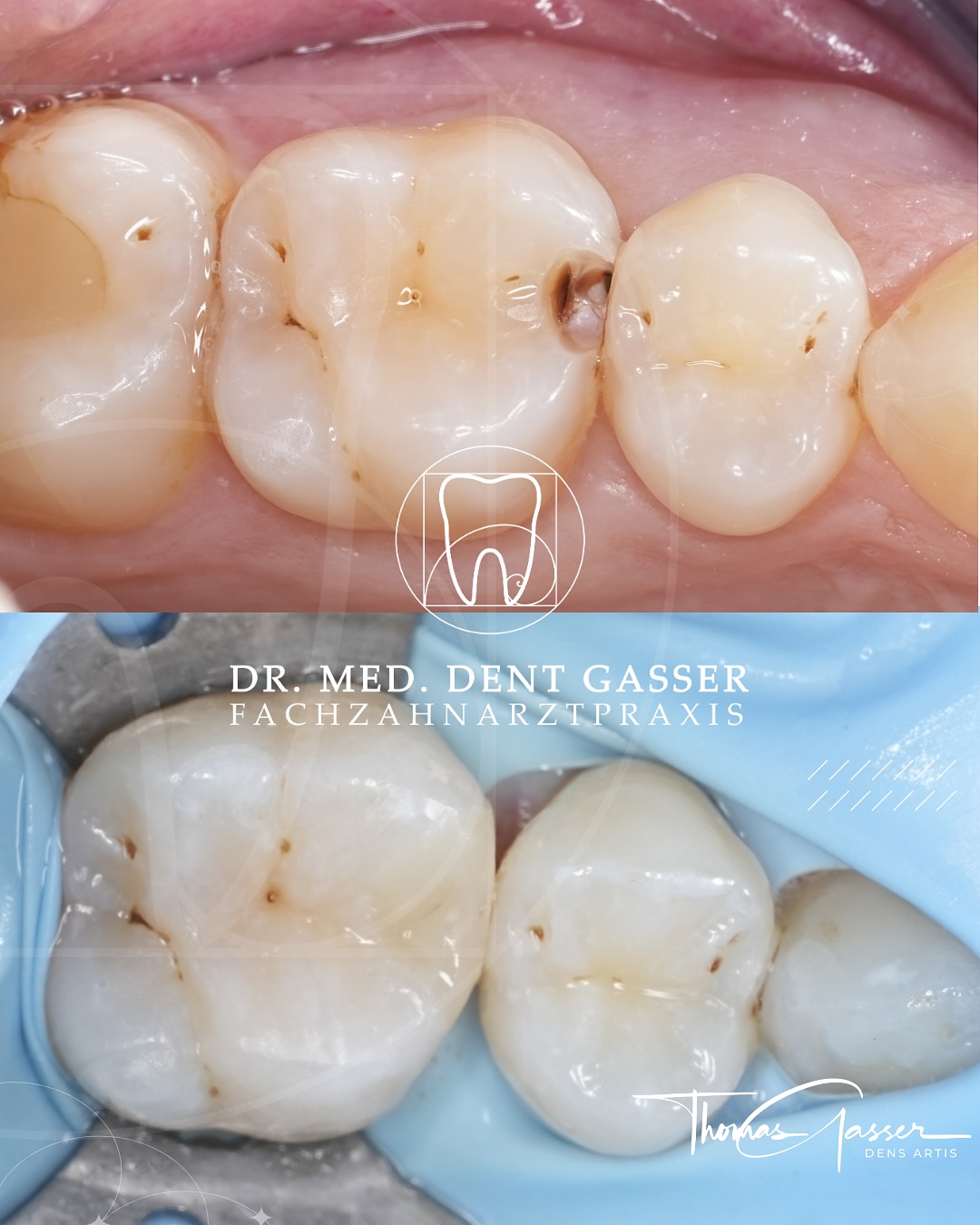 🦷 Zahnfüllungen neu gedacht: Ästhetisch, langlebig und minimalinvasiv
Zahnfüllungen gehören zu den häufigsten Behandlungen in der Zahnmedizin – und doch ist Füllung nicht gleich Füllung. Gerade alte oder defekte Versorgungen können im Laufe der Zeit undicht werden, sich verfärben oder die Zahnsubstanz schwächen. Moderne Materialien bieten hier heute weit mehr als bloße Reparatur.
➡️ Bei uns kommen hochwertige, zahnfarbene Kompositmaterialien zum Einsatz, die nicht nur stabil sind, sondern sich dem natürlichen Zahn optisch exakt anpassen.
➡️ Auch kleinere defekte Amalgamfüllungen lassen sich schonend ersetzen – für ein gesundes, harmonisches Gesamtbild im Mund.
💡 Vorteile moderner Füllungen:
✔️ Biokompatibel und metallfrei
✔️ Unsichtbar schön – perfekte Farbanpassung an den Zahn
✔️ Minimalinvasiv – maximaler Zahnerhalt bei kleinstmöglichem Substanzabtrag
✔️ Langlebig und belastbar – auch in stark beanspruchten Bereichen
Die moderne Füllungstherapie ist heute weit mehr als nur “ein Loch schließen” – sie ist ein entscheidender Baustein für funktionelle Stabilität, Zahnästhetik und langfristige Zahngesundheit.
📍 Fachzahnarztpraxis Dr. Thomas Gasser
Greifengasse 1, 4058 Basel
📞 +41 61 681 00 10
📧 fachzahnarztpraxis_basel@sso-hin.ch
🌐 www.densartis.ch
#Zahnfüllung #Kompositfüllung #Amalgamersatz #Zahnerhalt #ZahnarztBasel #GesundesLächeln #BaslerZahnarzt #Basel #BaselSwitzerland #Schweiz #Baselstadt #BaselLiebe #Zahnmedizin #Zahnarztpraxis #Zahngesundheit #ÄsthetischeZahnmedizin #Prophylaxe #Zahnerhalt #DrThomasGasser #ZahnarztpraxisBasel #ZahnmedizinMitHerz #Füllungstherapie #Minimalinvasiv #Zahnästhetik