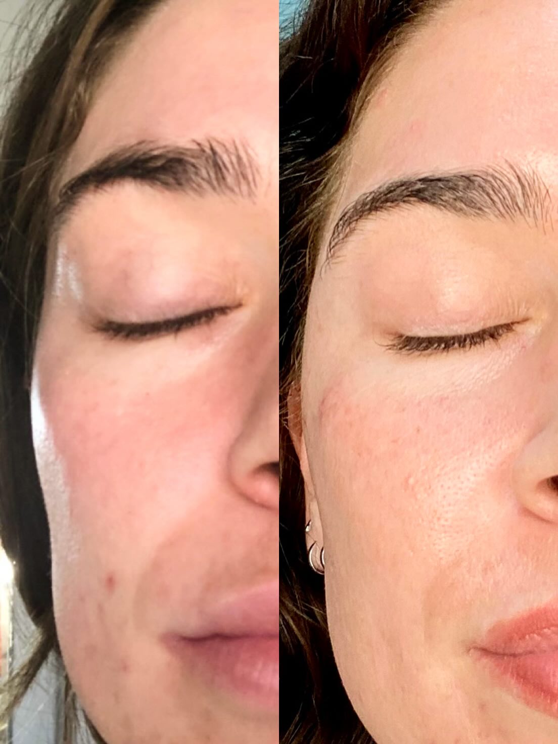 ✨ Rejuvenate your look with our Radiesse/Belotero blend – now available for:
🔹 Temples – $900
🔹 Cheeks – $900
🔹 Neck Treatment – $975
This collagen-stimulating procedure grows for up to 10 months and results can last 2–3 years! Natural-looking volume, long-term results.
📞 Call or DM us to book your appointment today!
#Radiesse #BeloteroBlend #FacialRejuvenation #DrDuponAesthetics #AntiAging #TempleFiller #CheekFiller #neckrejuvenation