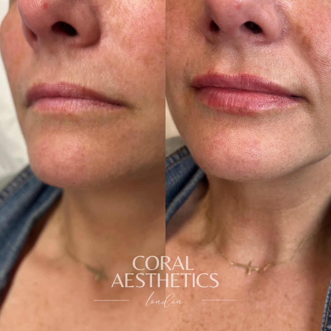 She waited until the end of the consultation.
After we’d talked through the treatment.
After the questions about price, longevity, downtime.
Then, quietly, like she wasn’t sure she was allowed to ask, she said it:
“But… what if something goes wrong?”
And honestly? It’s one of the most important questions you can ask.
Because this isn’t a massage.
It’s not a facial.
It’s not something you can wash off.
This is aesthetics. 💉
And when needles, anatomy, and product meet - things need to be done
properly.
So here’s the truth: Complications are rare — but they can happen.
And you deserve to know that.
Not in a scary, fear-mongering way…
but in an informed, grown-woman, I-deserve-to-feel-safe way.
That’s why I don’t just show you a treatment menu.
I show you my credentials.
I talk about vascular occlusion.
I talk about how to recognise it.
I talk about how I’m trained to act — calmly, quickly, and clinically — if anything ever does go wrong.
Because real confidence doesn’t come from silence. It comes from knowledge. From knowing your practitioner isn’t just good with a syringe, but also with the serious stuff.
So if you’re asking that question in your head, but feel awkward saying it out loud - please know: I want you to ask!
You have every right to feel safe. You have every right to choose someone who takes your face, your trust, and your wellbeing seriously.
❗️What if something goes wrong?
Then you’ll be in the hands of someone who’s trained for it. Who’s not just skilled - but responsible. Because beauty is nothing without safety. And peace of mind is part of the treatment.
#nurseledaesthetics #safetyinbeauty #naturallipfiller #beforeafterlips #medicalclinic #aestheticsessex