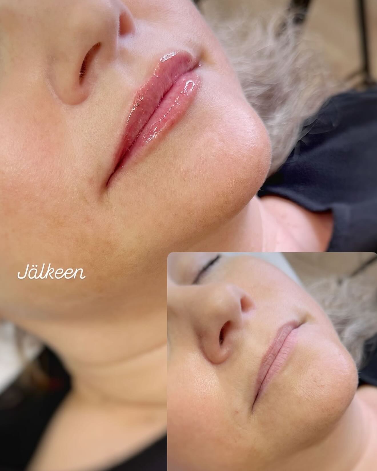 Tässä kahdet luonnollisesti täytetyt huulet kanyylitekniikalla ja pehmeällä täyteaineella.
Selkeästi asiakkaani jakaantuvat muhkeiden huulien ystäviksi ja luonnollisten huulien ystäviksi. 💋✨
Onneksi molemmat vaihtoehdot on mahdollisia! Voimme yhdessä suunnitella ja valita aineen paikan päällä. Kysyn aina asiakkaan toiveita huulien lopputuloksen suhteen.
Kanyyli aiheuttaa vähemmän mustelmia ja kipua hoidon aikana, kuin neula. Tämä on hyvä tekniikka etenkin luonnolliseen korostukseen.