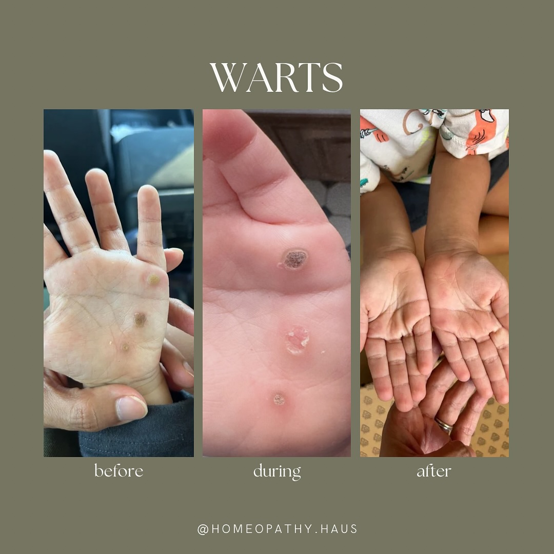 Bye warts💥👋🏼
Swipe to see how the healing unfolded…
This is healing from the inside out, from the deeper emotional layers to the surface.
When we support the whole child, the body knows exactly what to do 🤍
#homeopathy #naturalhealing #warthealing #healingfromwithin #emotionalhealing #childrenshealth #holisticparenting #energeticmedicine #homeopathyforchildren #realresults #trusttheprocess #directionofcure #wholechildapproach #gentlehealing