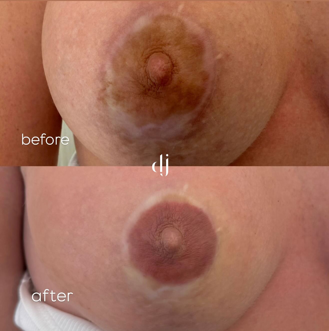 Medical Tattoo results working with post surgery & mastectomy reconstruction
Here you can see medcial needling scar work using our bespoke program and after care followed by areola pmu medical tattoo
This client is returning to further perfect her results with some camouflage tattoo to conceal the look of the scarring that is left which is a optional add on treatment once the scarring is dramatically improved
No laser has been used to achieve these results
As always the goal in clinic is the results of before & after that aim to help improve the confidence of our beautiful clients.
Consultation is required for all Medical PMU & Scar Revision treatments
Danielle x
#pmu #pmuartist #medicaltattoo #camoflaugetattoo #areolatattoo #mastactomytattoo #mastactomy #scarevision #permamentmakeup #killerbeautypmu #semipermanentmakeup #areolatattooliverpool #daniellejamesclinic