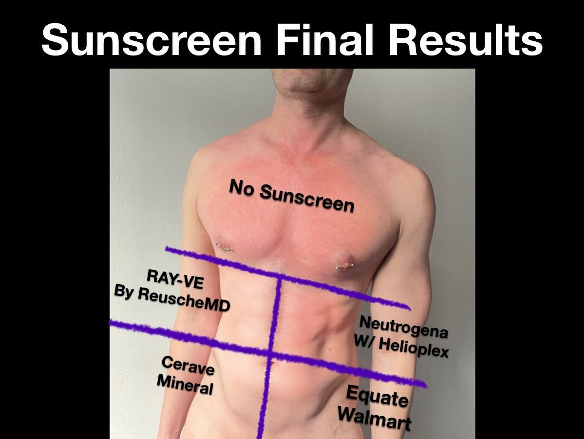 And the results are in! Sunscreen will be coming in July! Both RAY-VE by ReuscheMD and CeraVe protected equally! While CeraVe is mineral so leaves a white sheen but offers solid protection ReuscheMD offered same protection without a sheen thus great for face if wanting to be out and photographed! Neutrogena and Equate did protect some when compared to areas without sunscreen but didn’t do as good of a job. #ReuscheMD #Sunscreen #Pride #TakePrideInYourSkin