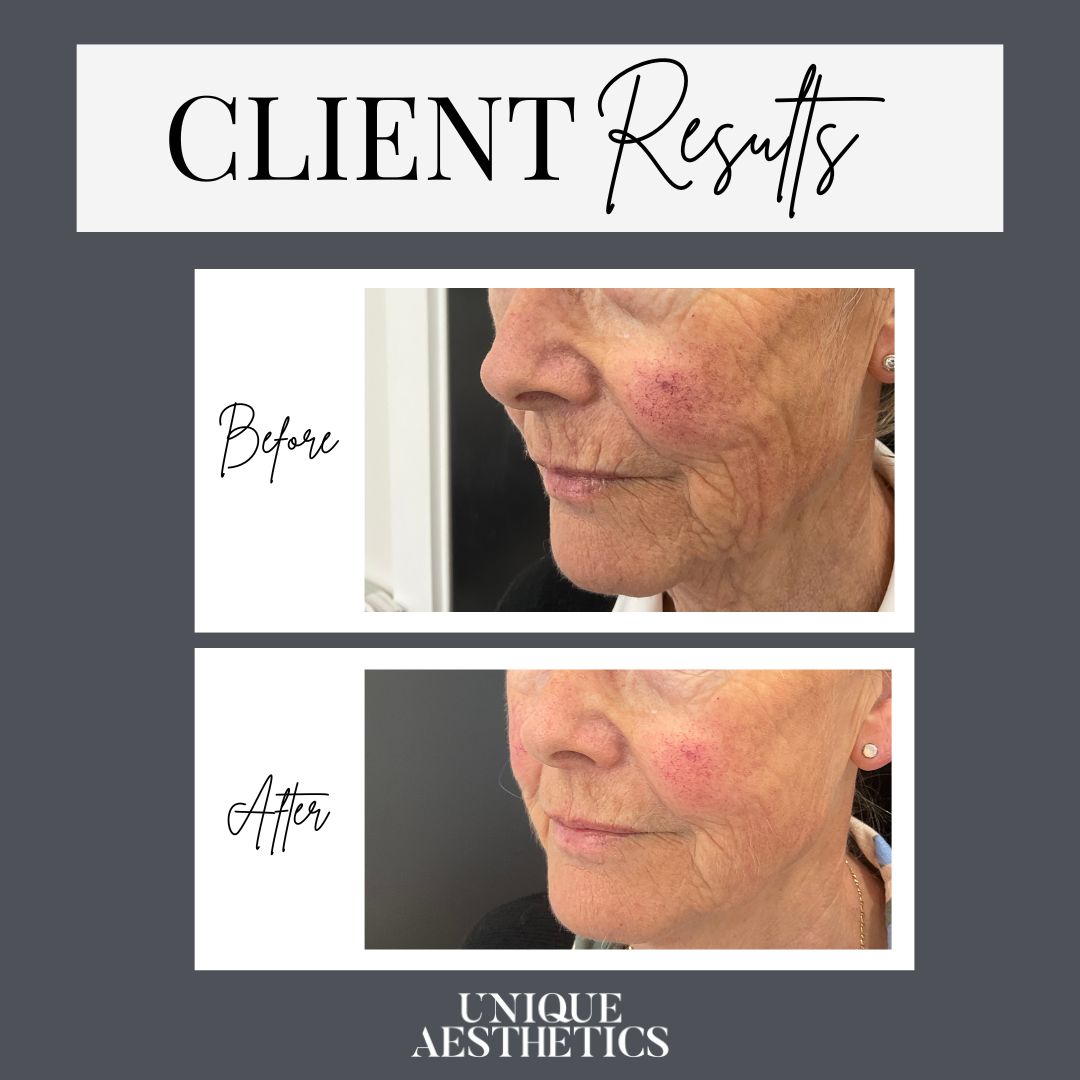 RADIESSE® is made from calcium hydroxylapatite spheres. Vertically lifts for immediate volume correction.
Stimulates collagen to increase your skin’s thickness and smooth texture. Results are natural and work with your own collagen to provide long lasting results. Radiesse ® injectable implant is intended for plastic and reconstructive surgery, including deep dermal and sub-dermal soft tissue augmentation of the facial area and dorsum of the hands.
Radiesse ® injectable implant is indicated for: the treatment of nasolabial folds, marionette lines or jawline; the augmentation of cheeks; the hand augmentation to correct volume loss in the dorsum of the hands; and the restoration and /or correction of the signs of facial fat loss (lipoatrophy) in people with human immunodeficiency virus.
Radiesse ® (+) Lidocaine injectable implant is intended for plastic and reconstructive surgery, including deep dermal and sub-dermal soft tissue augmentation of the facial area and dorsum of the hands in adults. Radiesse ® (+) Lidocaine injectable implant is indicated for: the treatment of nasolabial folds, marionette lines and jawline; the augmentation of cheeks;
hand augmentation to correct volume loss in the dorsum of the hands; the restoration and/or correction of the signs of fat or volume loss (lipoatrophy) in the facial area and for rejuvenation of the hands fat loss (lipoatrophy) in people with human immunodeficiency virus.
You should tell your practitioner and avoid treatment with Radiesse ®/ Radiesse ® (+) Lidocaine if you: have had an allergic reaction to any of the ingredients or have severe allergies including anaphylaxis; if you tend to develop keloids or heavy scars; have any bleeding disorders, poor wound healing; inflamed or infected skin; are under the age of 18; are pregnant or breastfeeding.
Please inform your practitioner of any diseases you have or have had. These include in particular cardiovascular diseases, autoimmune diseases, diabetes, tumors, skin infections or severe allergies. If you take medication or vitamins, have had previous cosmetic procedures, or have been treated with other implants, please inform your practitioner.
Always read the label.