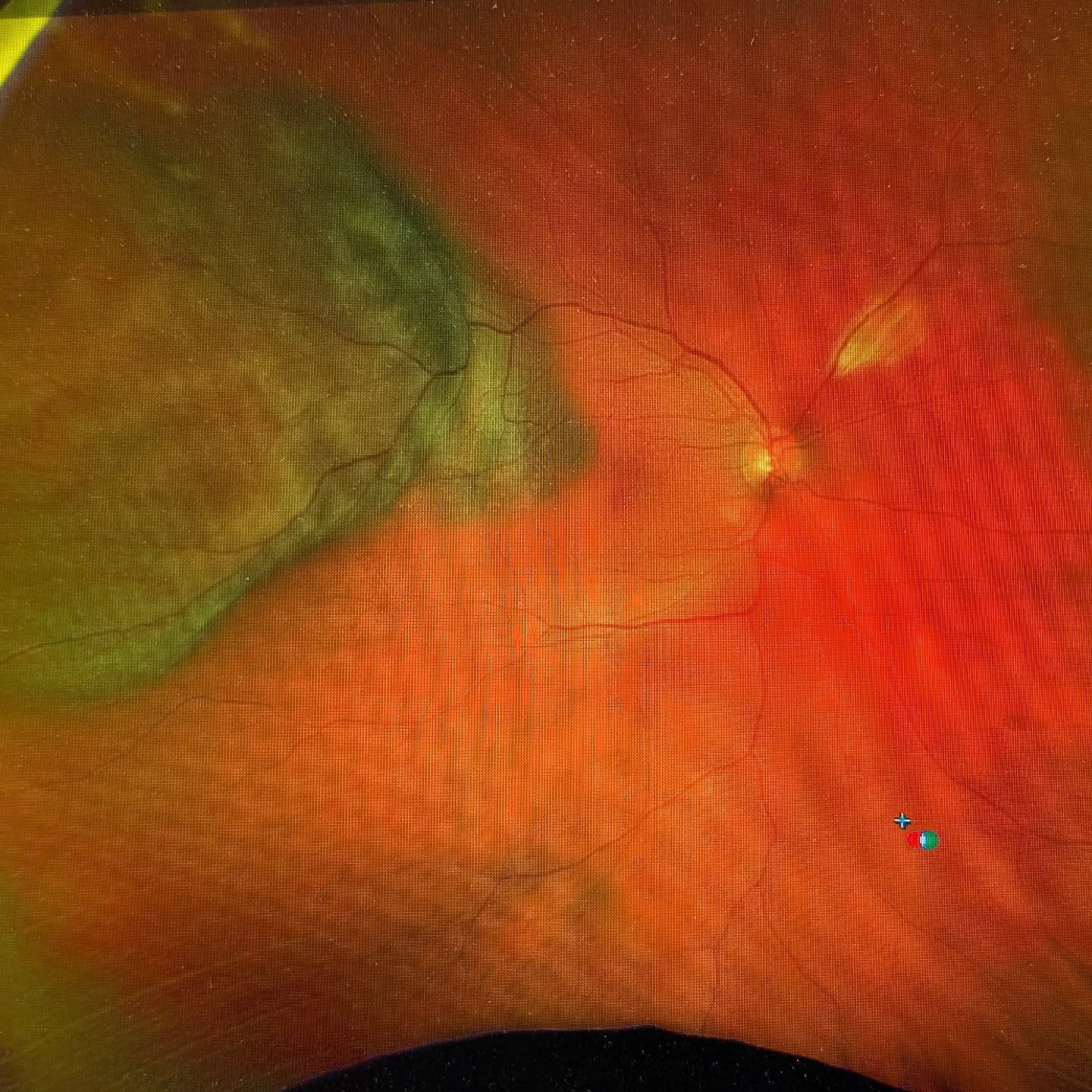 This patient came in for reading glasses and left with a referral to ocular oncology.
Even though choroidal melanoma is very rare (4-6 per million according AAO) it does happen and doesnt have symptoms.
#travelingeyedoc #notretinal #dontsmoke #notthere2yearsago #newbergfamilyeyecare #newbergeyes #sherwoodeyes #maceyes