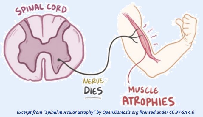 ✨ 2016 Breakthrough in Rare Disease Treatment
The FDA approves nusinersen (Spinraza) — the first-ever treatment for spinal muscular atrophy (SMA), a devastating genetic disorder and leading inherited cause of infant death.
🔬 Backed by NINDS-supported research, this therapy:
🔹 Targets the genetic root of SMA
🔹Boosts production of a vital protein
🔹 Offers real hope when given early
This also marks the first successful use of antisense oligonucleotide therapy to treat a neurological disease — a major leap in precision medicine.
Make sure you follow @americanbrainco to learn more about NINDS and its major milestones! #NINDS75 #ABrainCoProud