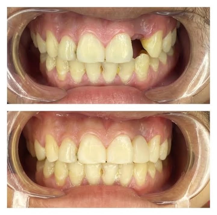 fibre-reinforced composite (FRC) bridge is a dental prosthesis used to replace missing teeth, particularly in the anterior (front) region of the mouth. It utilizes a combination of composite resin and reinforcing fibers. FRC bridges are a minimally invasive and often cost-effective alternative to traditional fixed bridges or implants, and they can often be completed in a single visit.
#compositebridges #fixyoursmile #teethcare