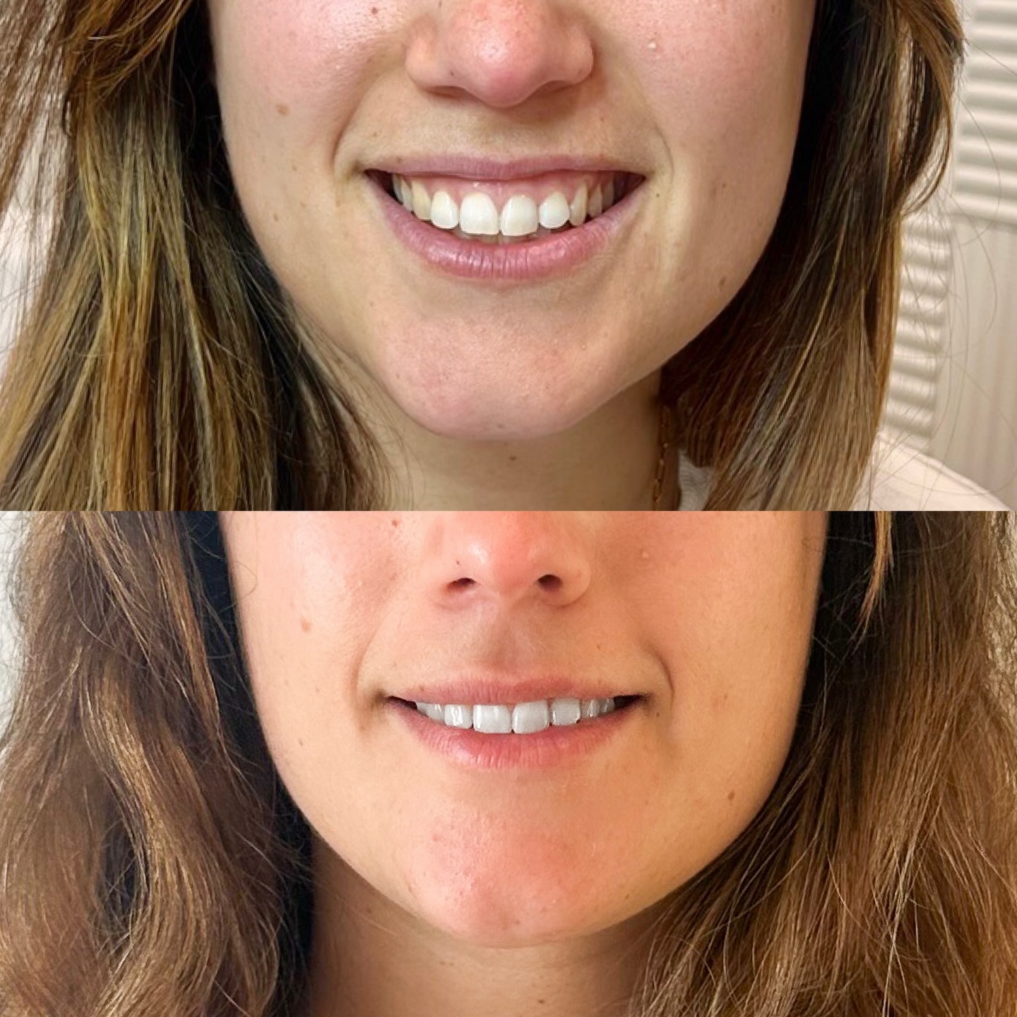 Ne soyez plus complexé(e) par votre merveilleux sourire. Grâce au botox il est possible de traiter ce que l’on appelle le sourire gingival (gummy smile).
Résultat un sourire rayonnant le tout en 10 min.
N’hésitez pas à prendre votre rendez-vous 📩